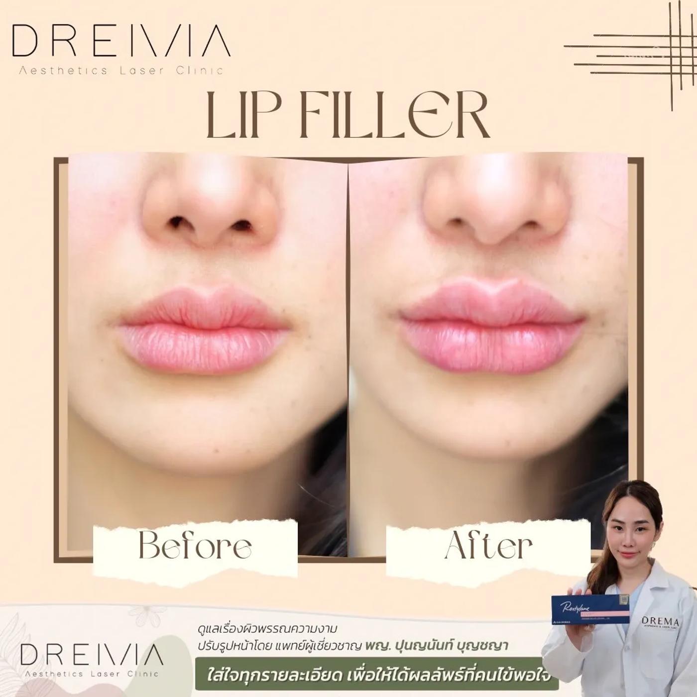 รีวิว Filler ปาก 14