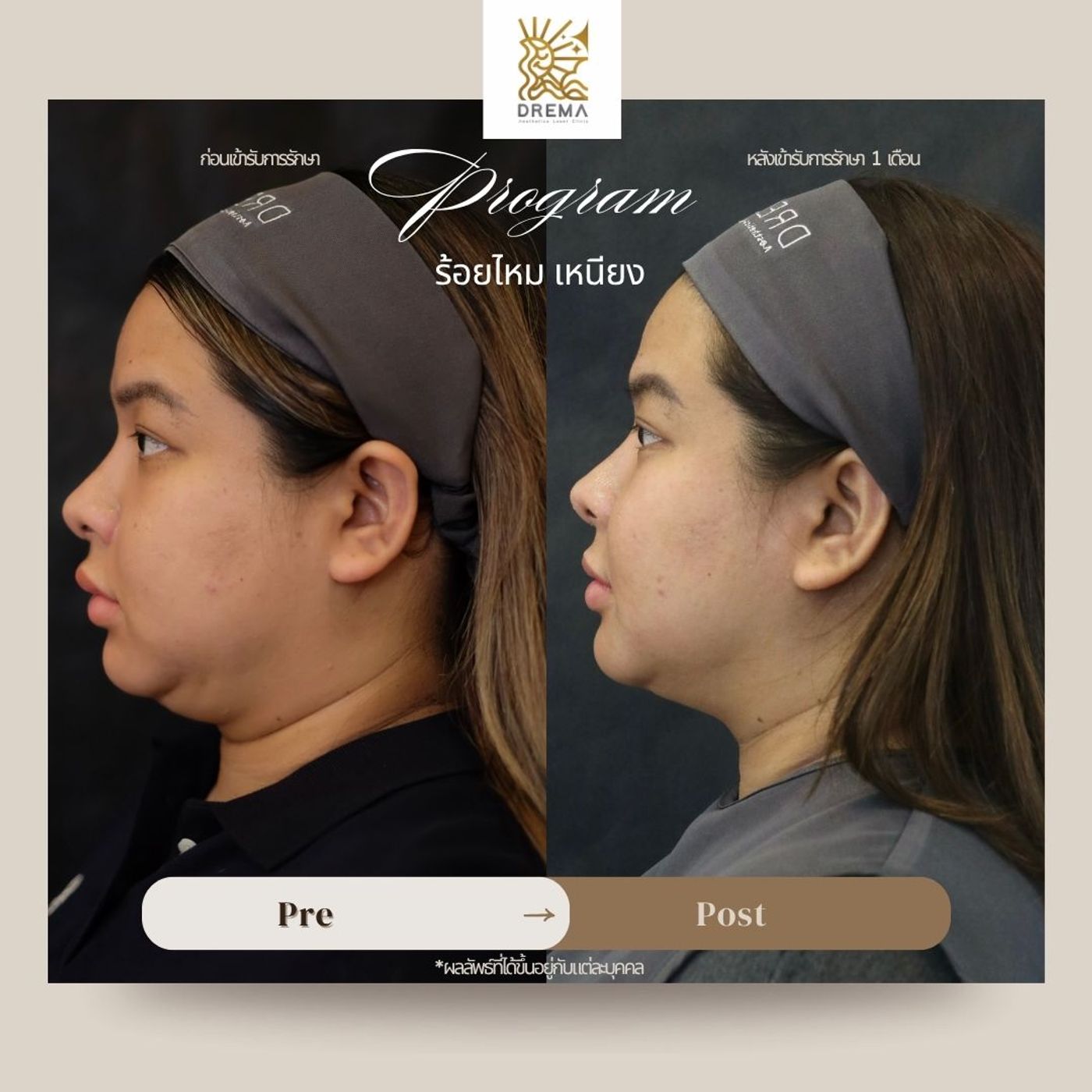 รูปรีวิว ร้อยไหม Drema Clinic เคสที่ 9