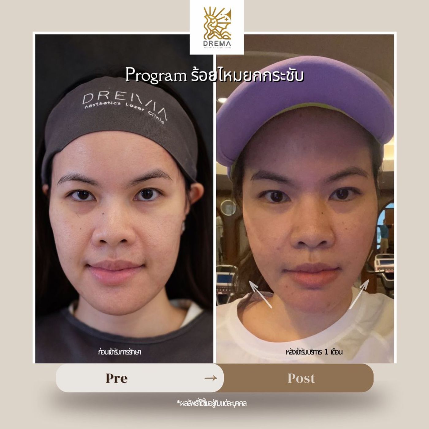 รูปรีวิว ร้อยไหม Drema Clinic เคสที่ 6