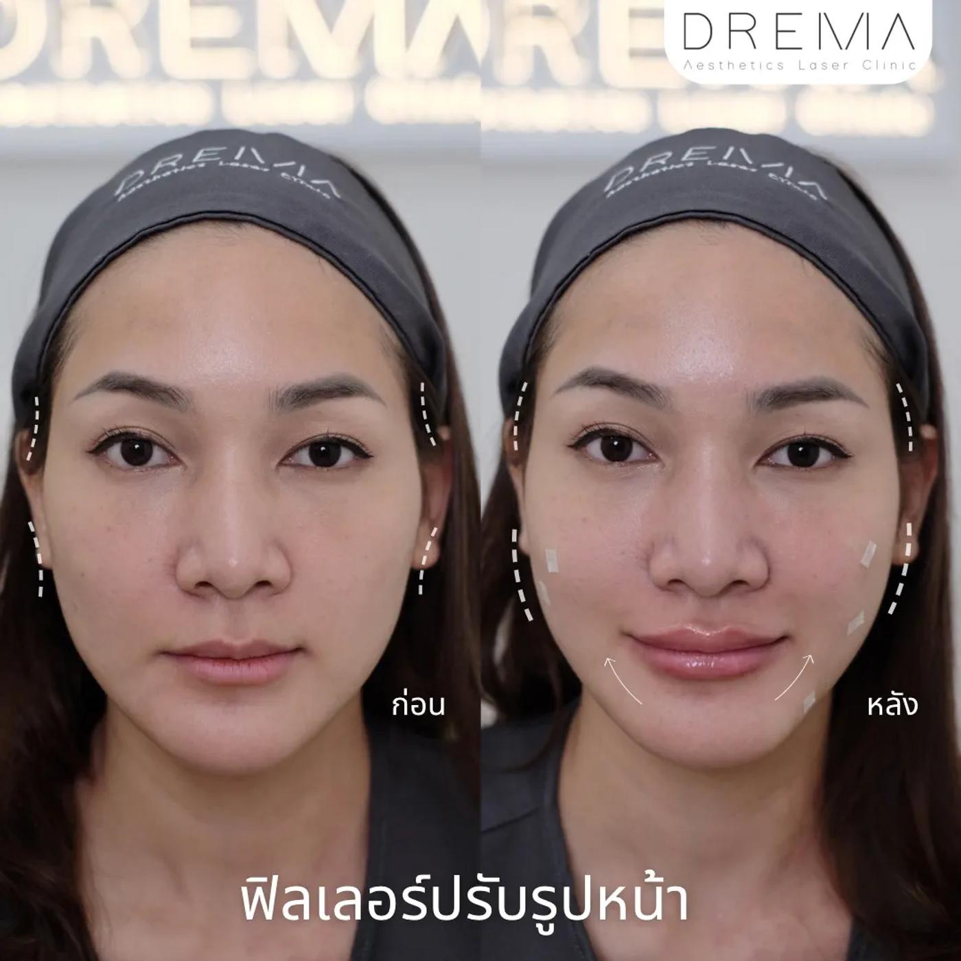 รีวิวการปรับรูปหน้า 6