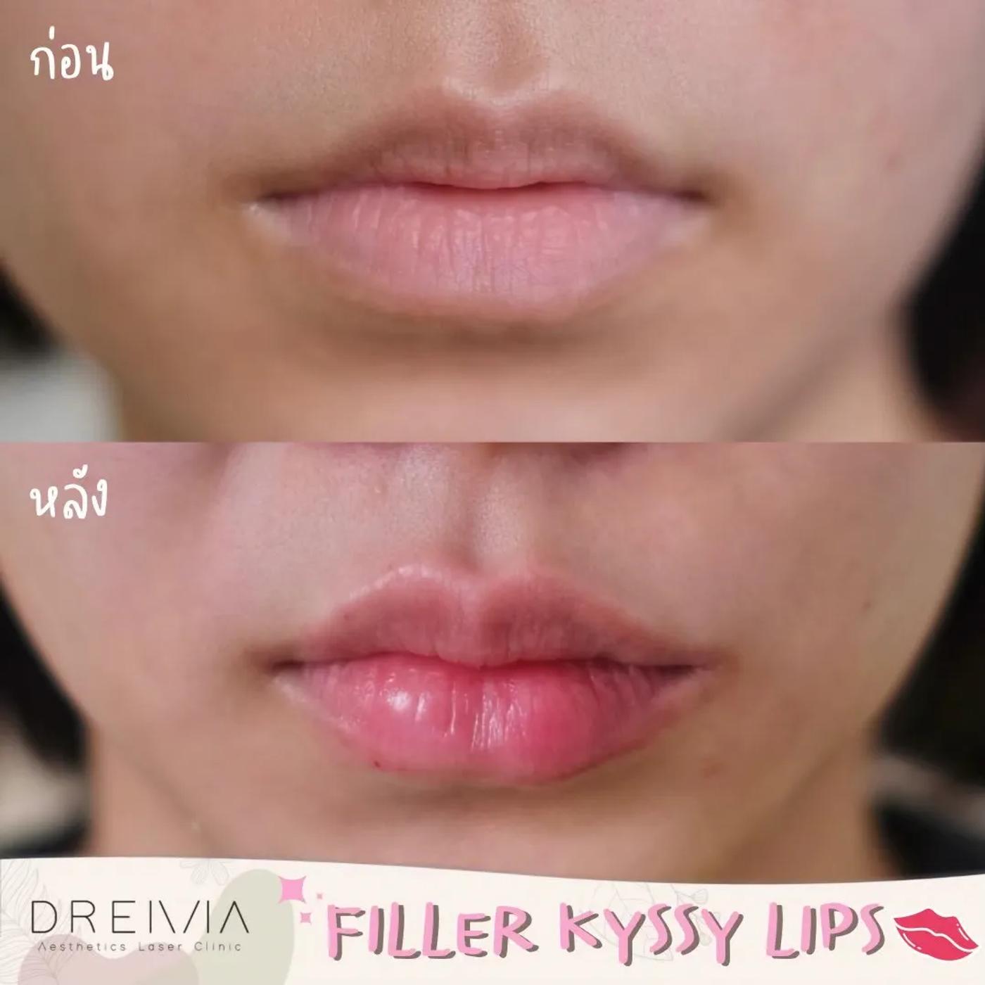 รีวิว Filler ปาก 11