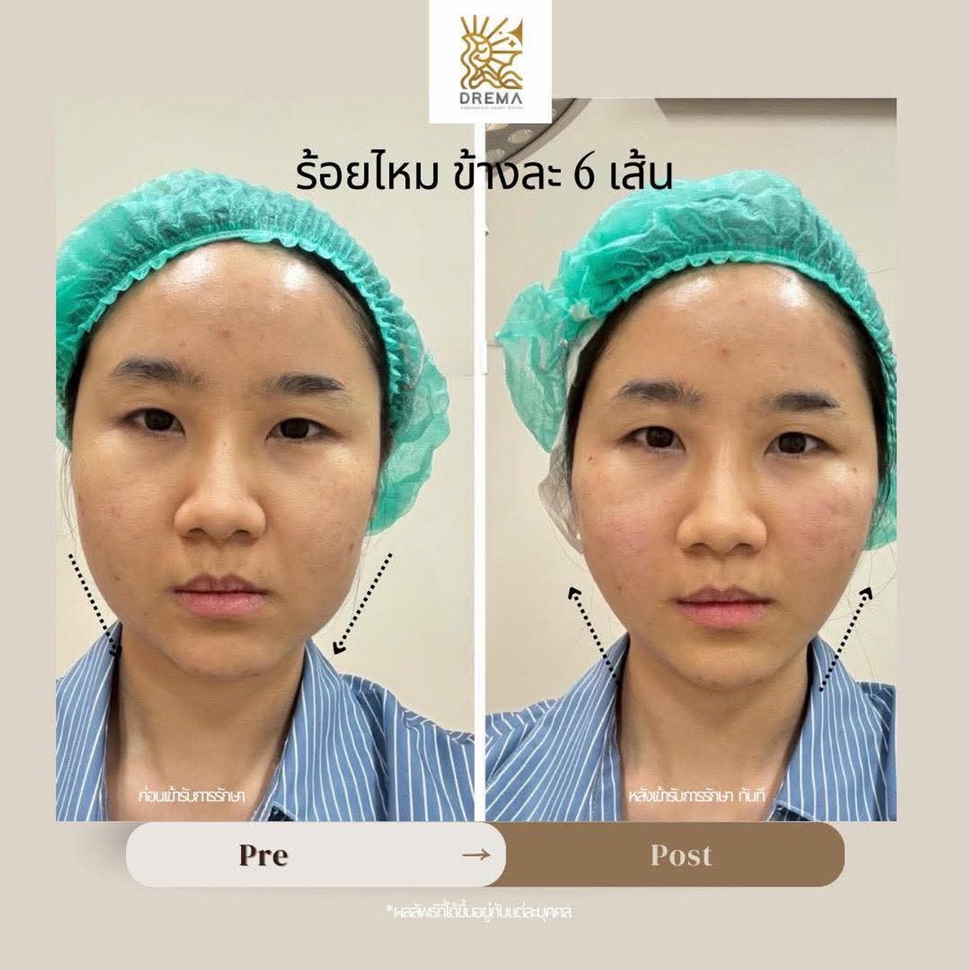 รูปรีวิว ร้อยไหม Drema Clinic เคสที่ 37