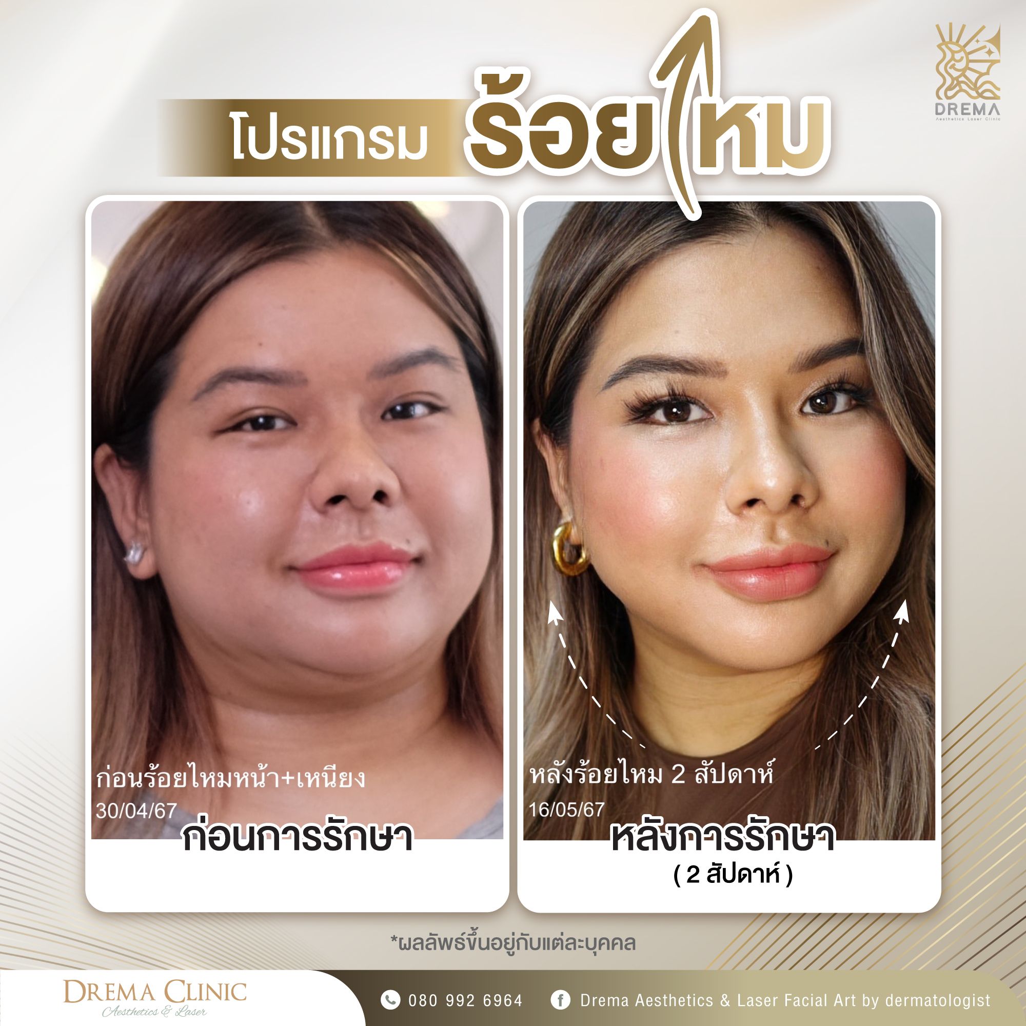 ภาพก่อนและหลังร้อยไหมเหนียง