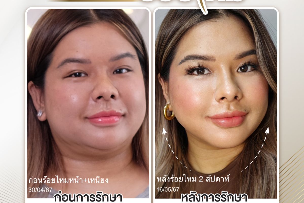 ภาพก่อนและหลังร้อยไหมเหนียง