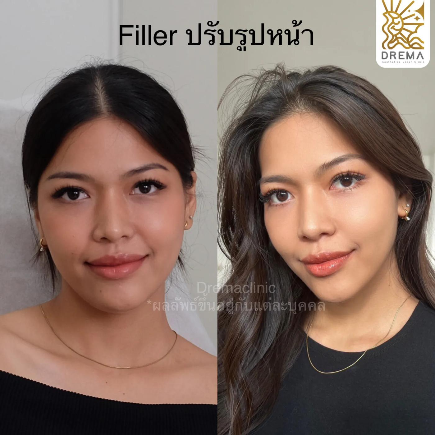 รีวิวการปรับรูปหน้า 2