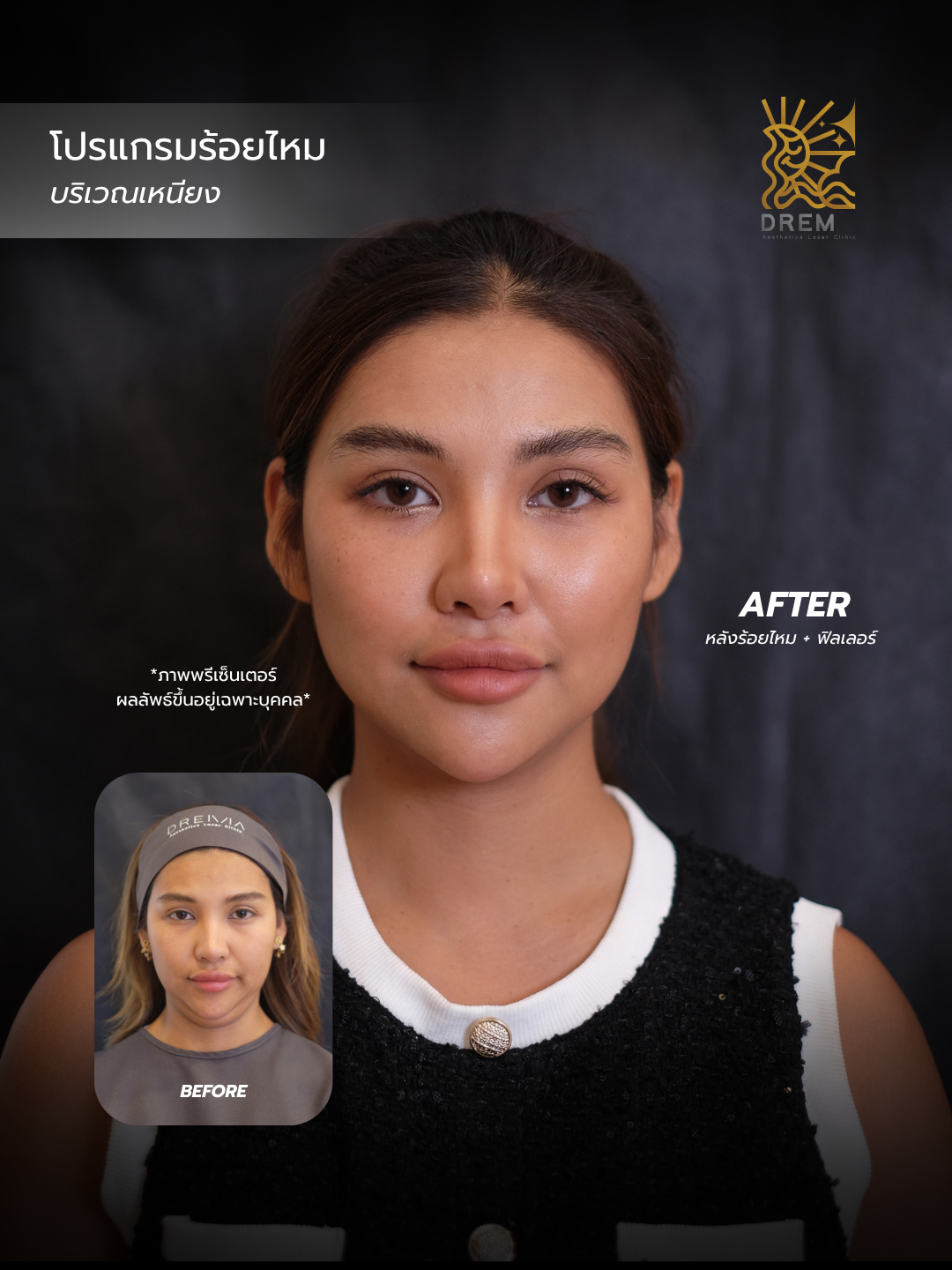 ภาพก่อนและหลังร้อยไหมที่บริเวณเหนียง