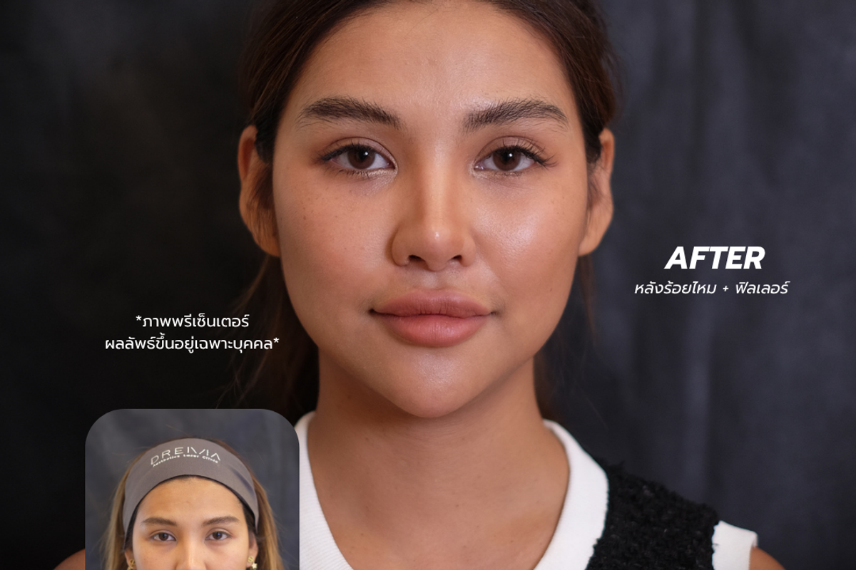 ภาพก่อนและหลังร้อยไหมที่บริเวณเหนียง
