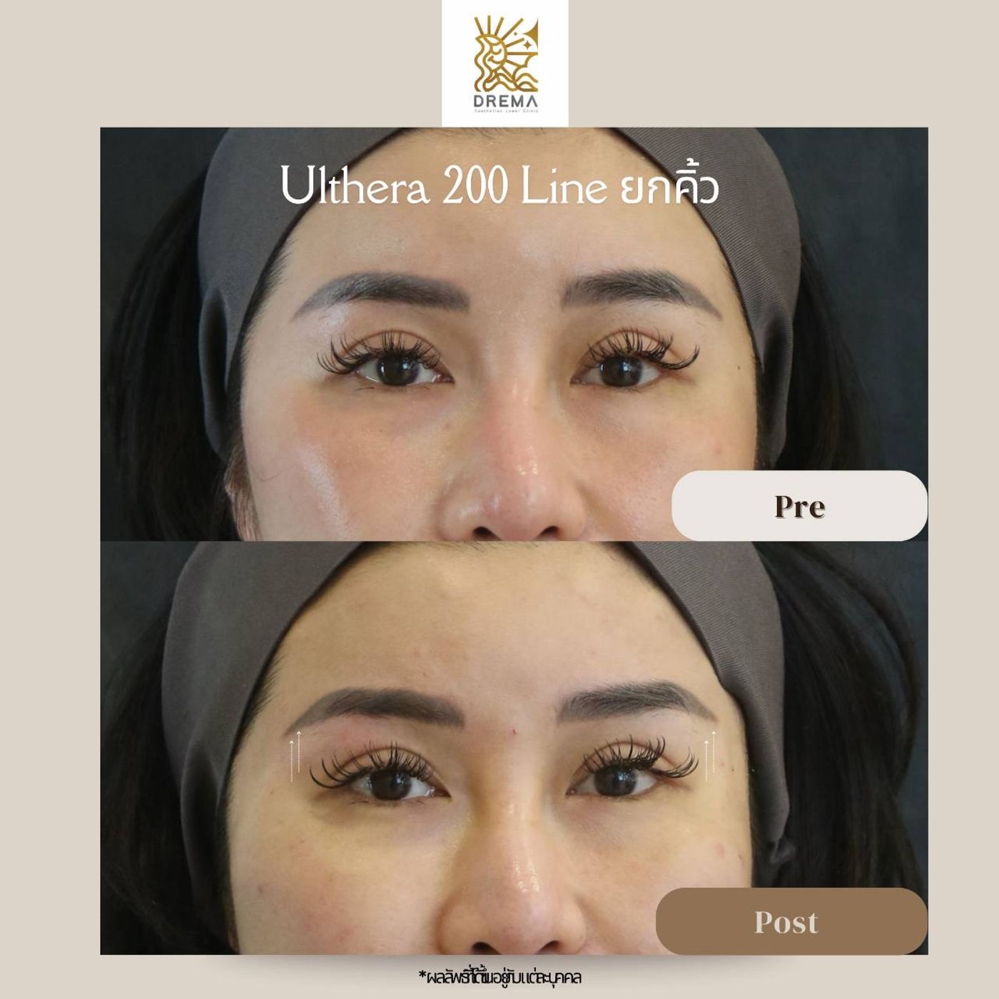 รูปรีวิว Ulthera Drema Clinic เคสที่ 10