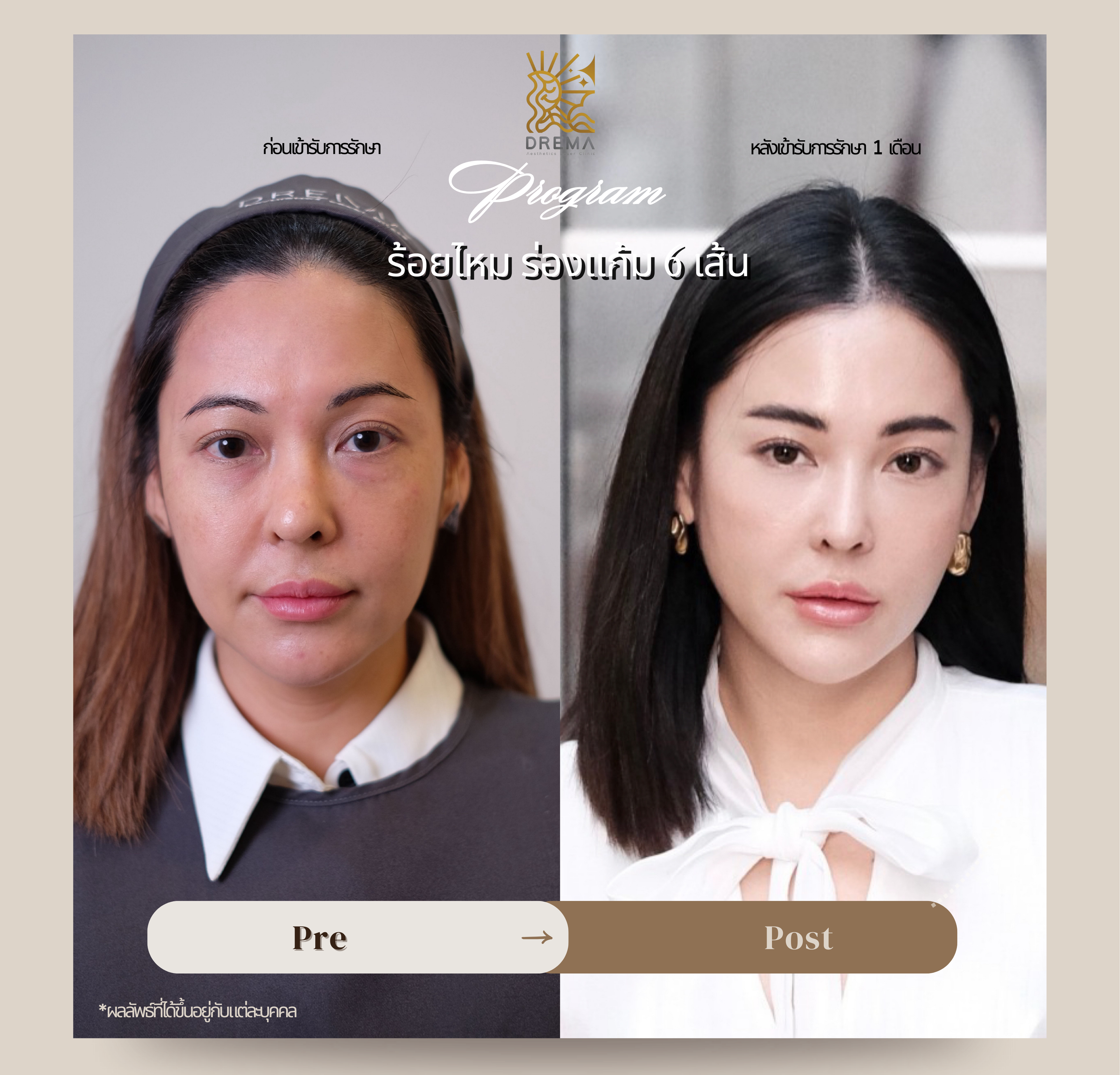 รูปรีวิว ร้อยไหม Drema Clinic เคสที่ 23