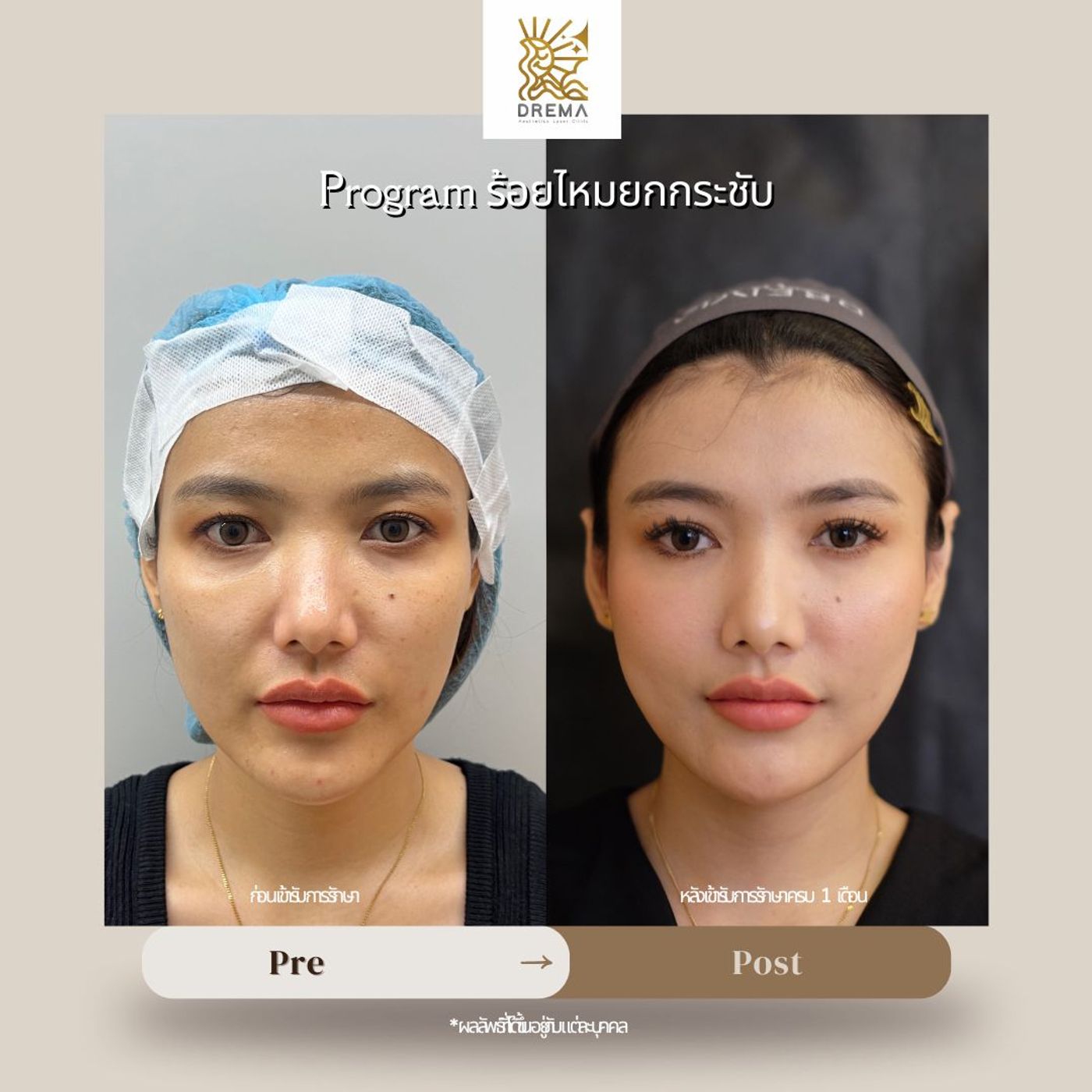 รูปรีวิว ร้อยไหม Drema Clinic เคสที่ 5
