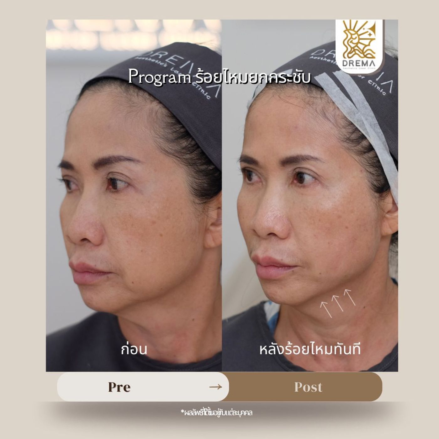 รูปรีวิว ร้อยไหม Drema Clinic เคสที่ 3