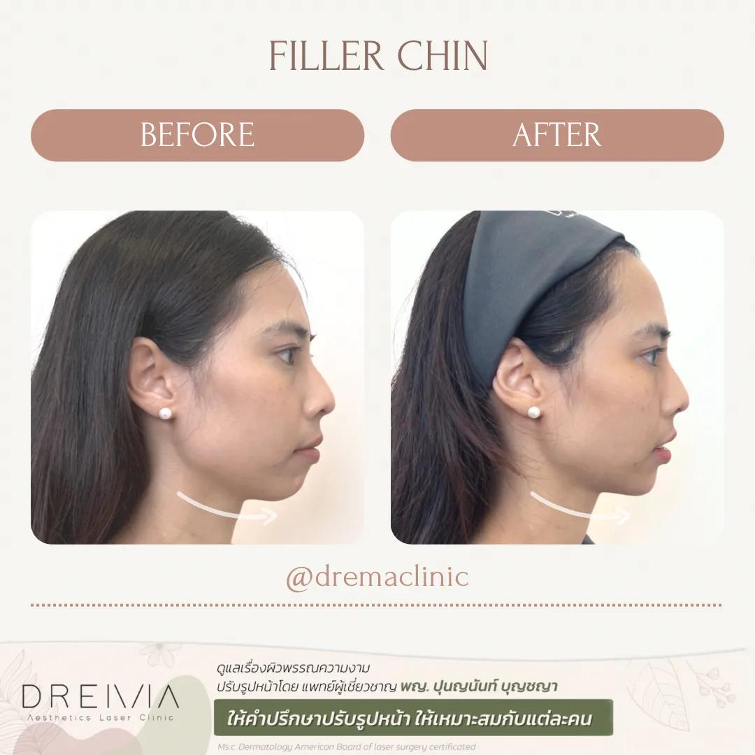 รีวิว ฟิลเลอร์คาง 1