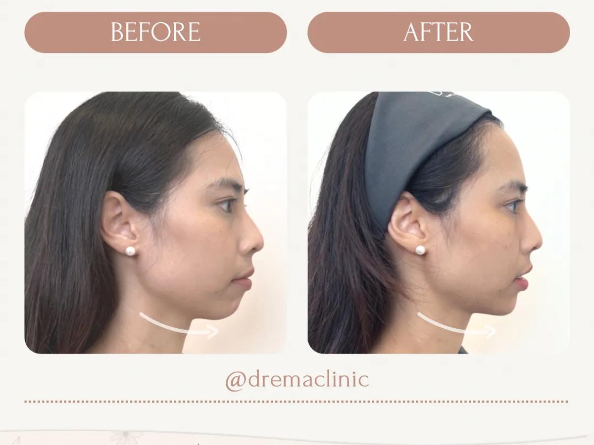 รีวิว ฟิลเลอร์คาง 1
