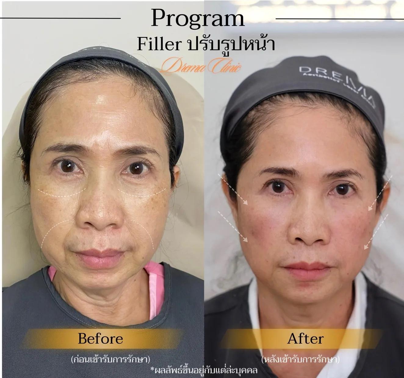 รีวิวการปรับรูปหน้า 22