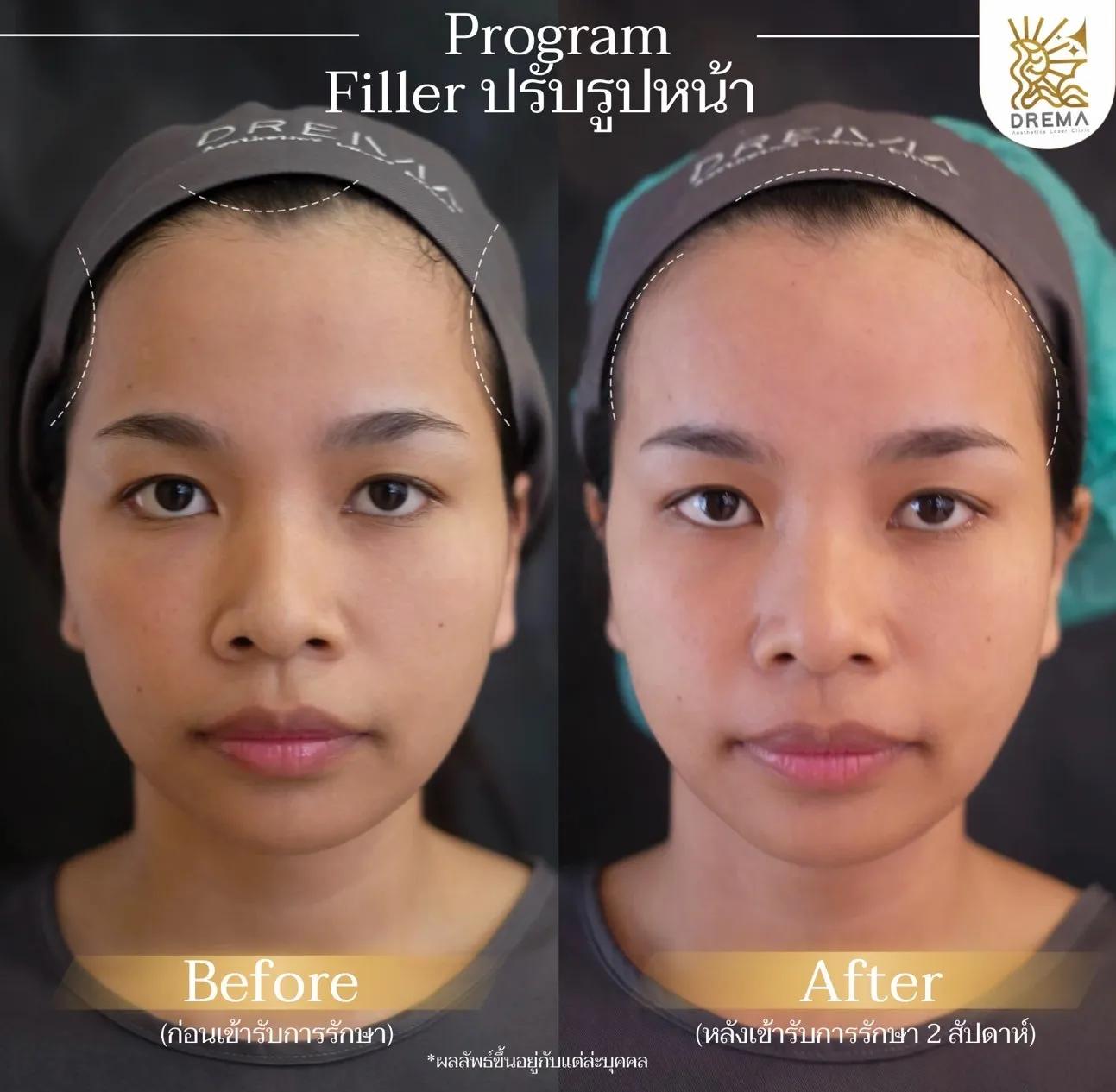 รีวิวการปรับรูปหน้า 24