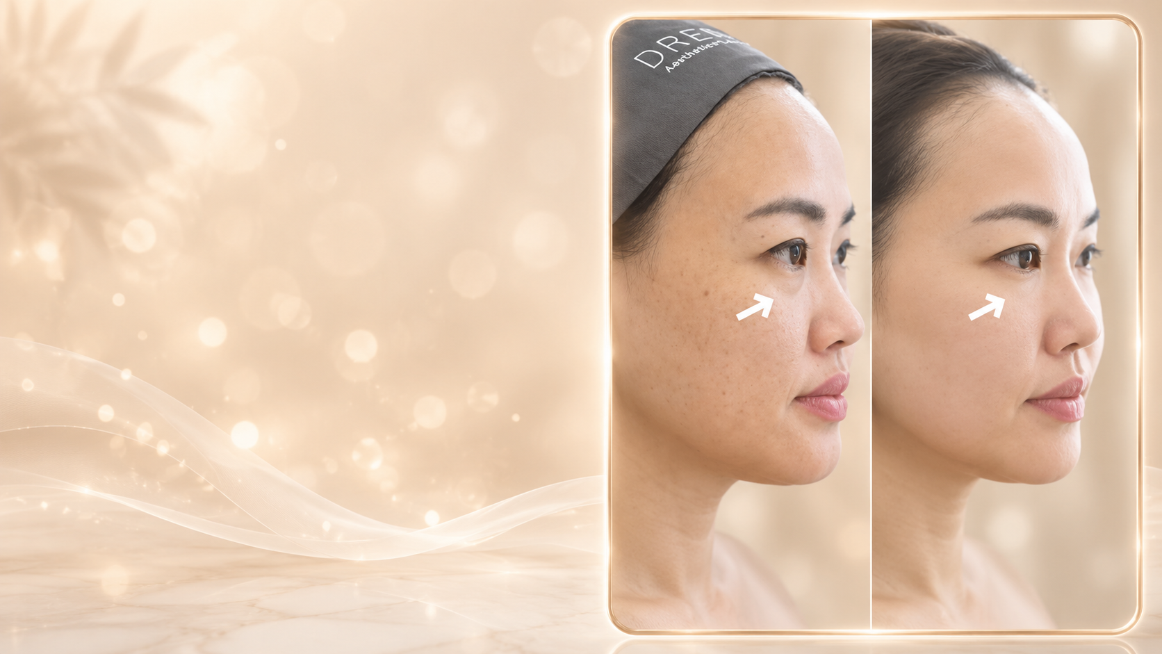 Under-Eye Filler Reviews
