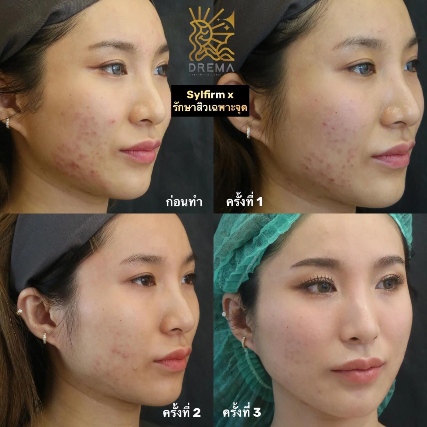 รีวิว SYLFIRM X 30