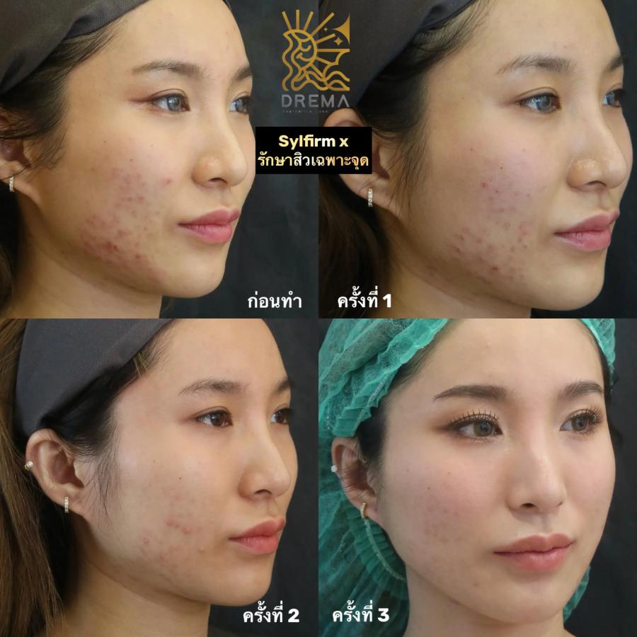 Sylfirm X ตัวช่วยจบปัญหาหลุมสิว ฝ้า รูขุมขน เผยผิวเรียบเนียนดูอ่อนเยาว์