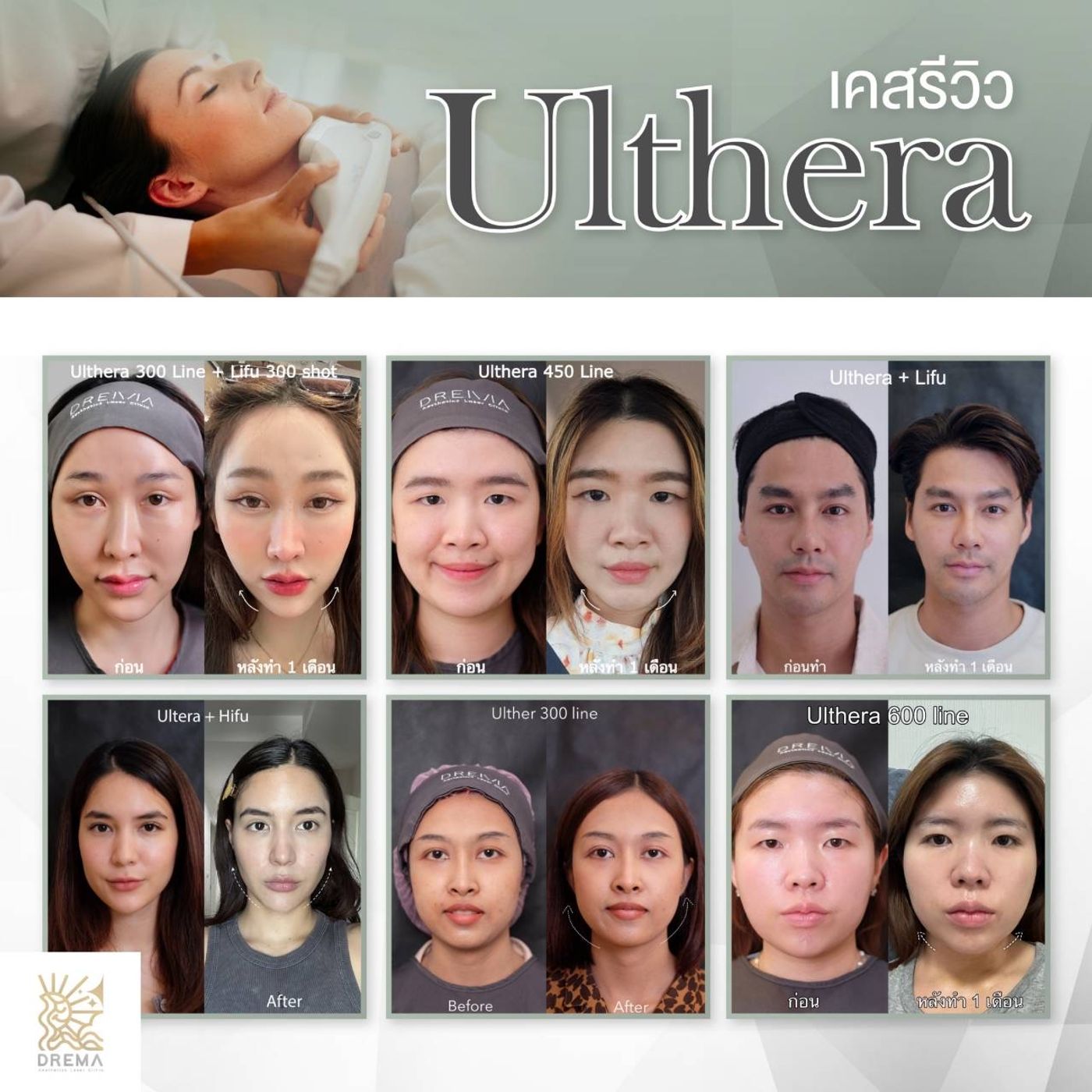 รูปรีวิว Ulthera Drema Clinic เคสที่ 12
