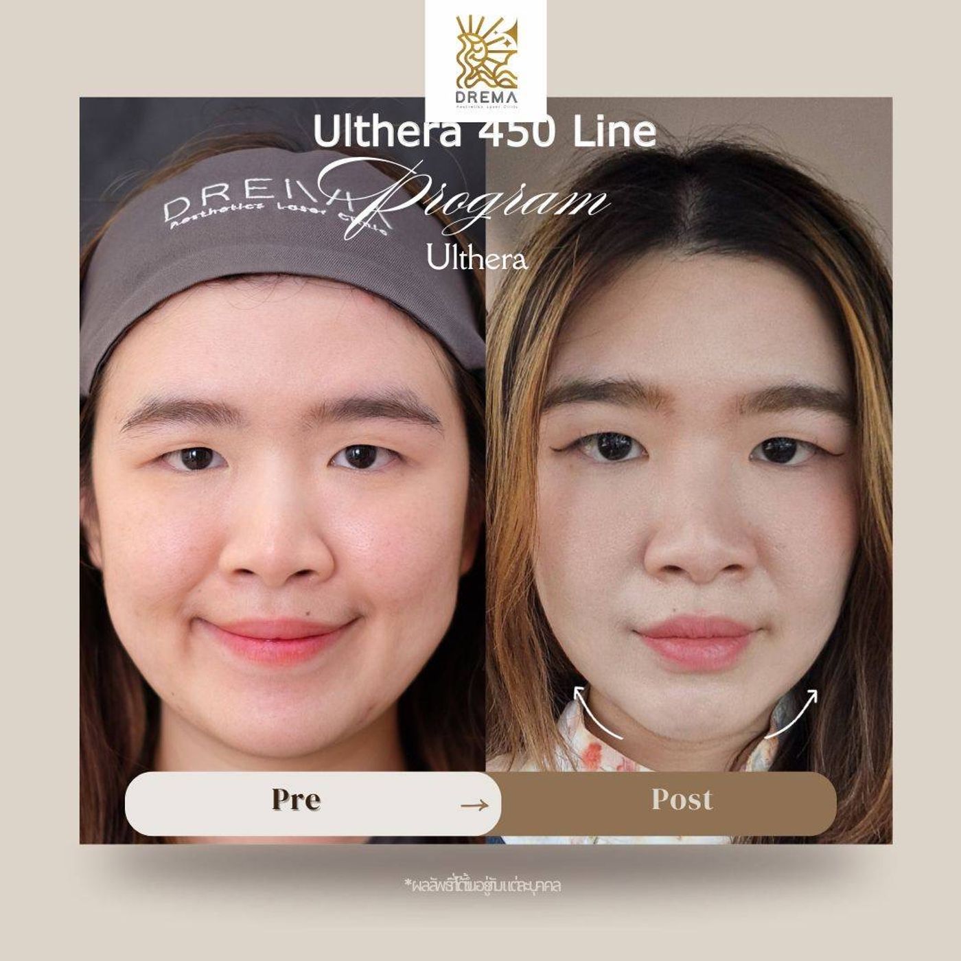 รูปรีวิว Ulthera Drema Clinic เคสที่ 4