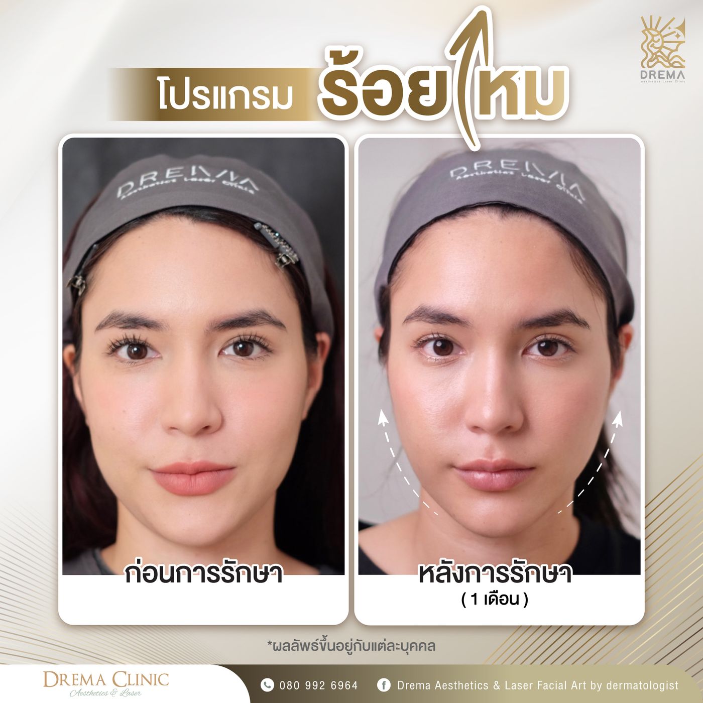 รูปรีวิว ร้อยไหม Drema Clinic เคสที่ 20