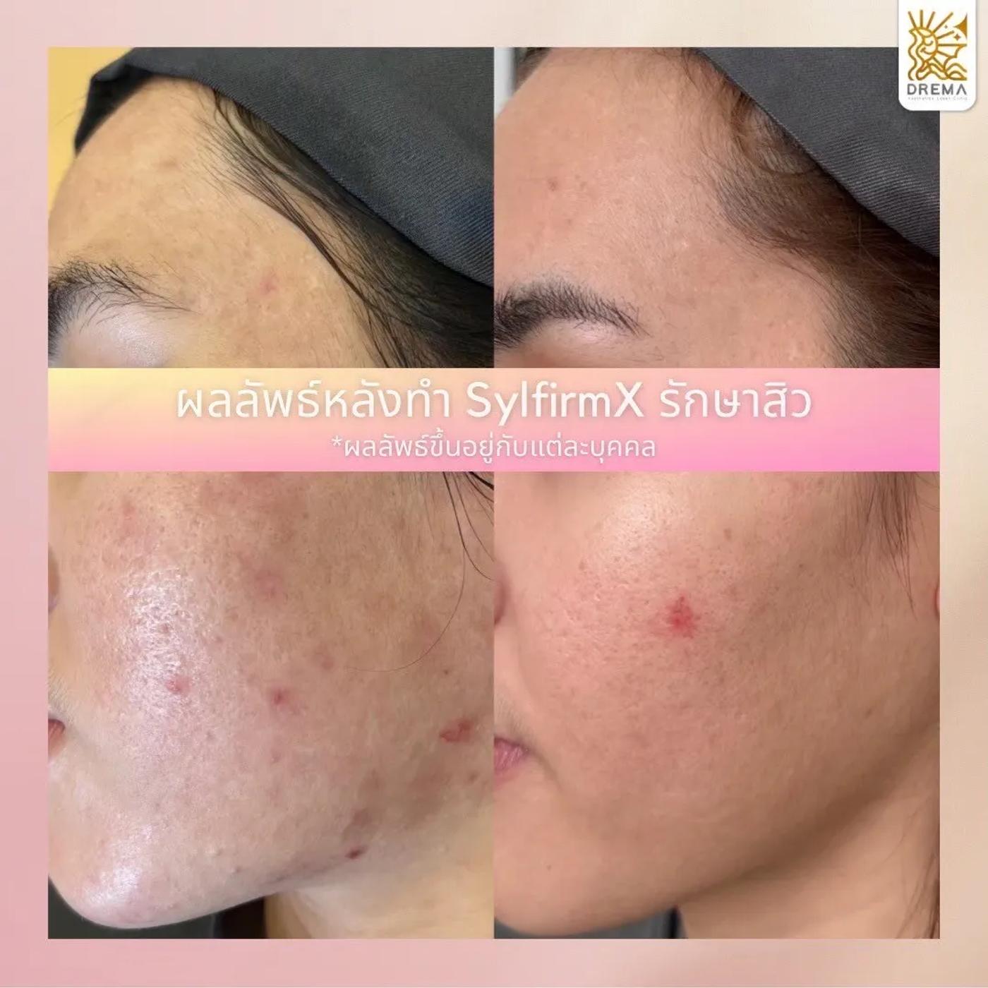 รีวิว SYLFIRM X 22