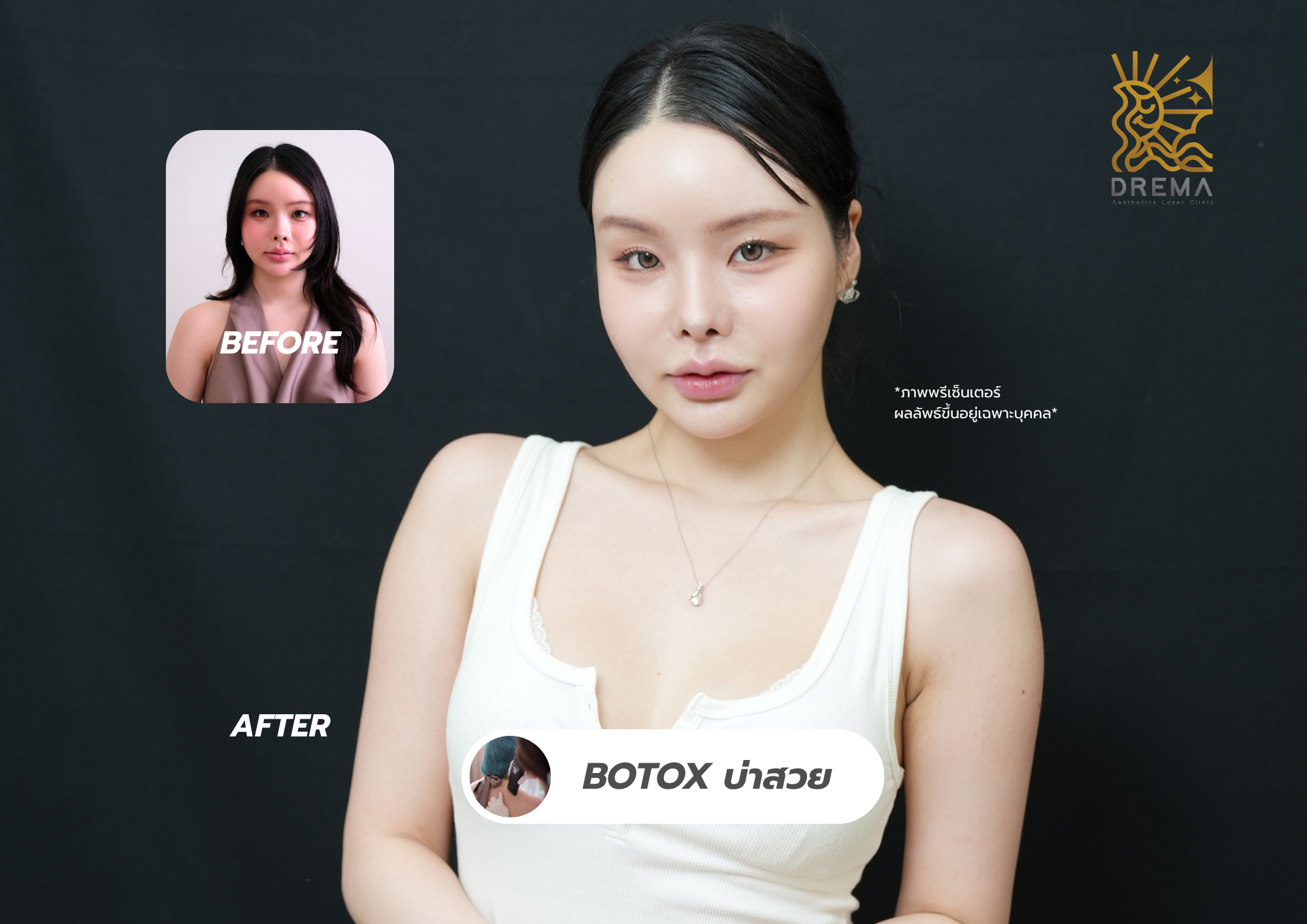 Botox บ่า