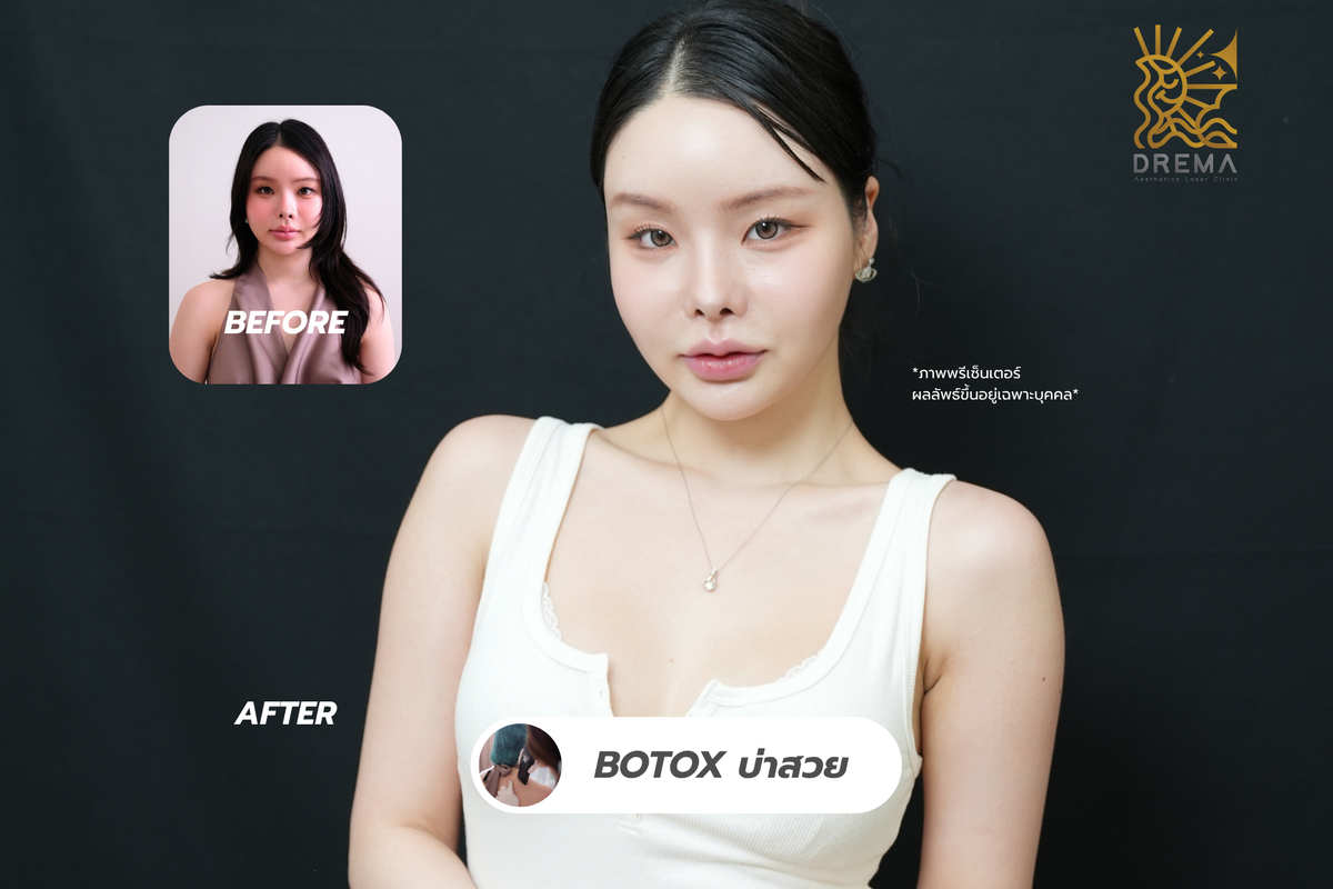 Botox บ่า