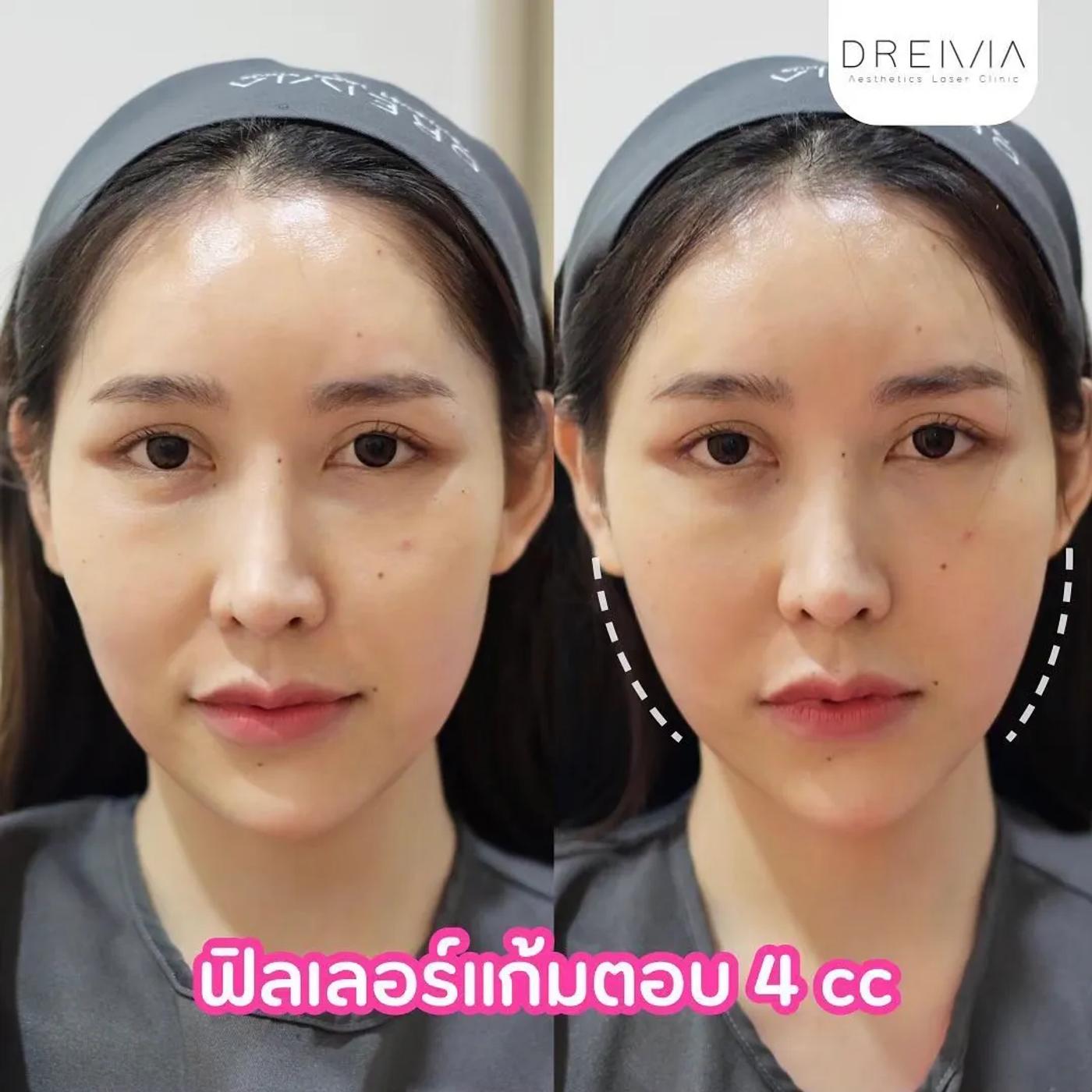 รีวิวการปรับรูปหน้า 9
