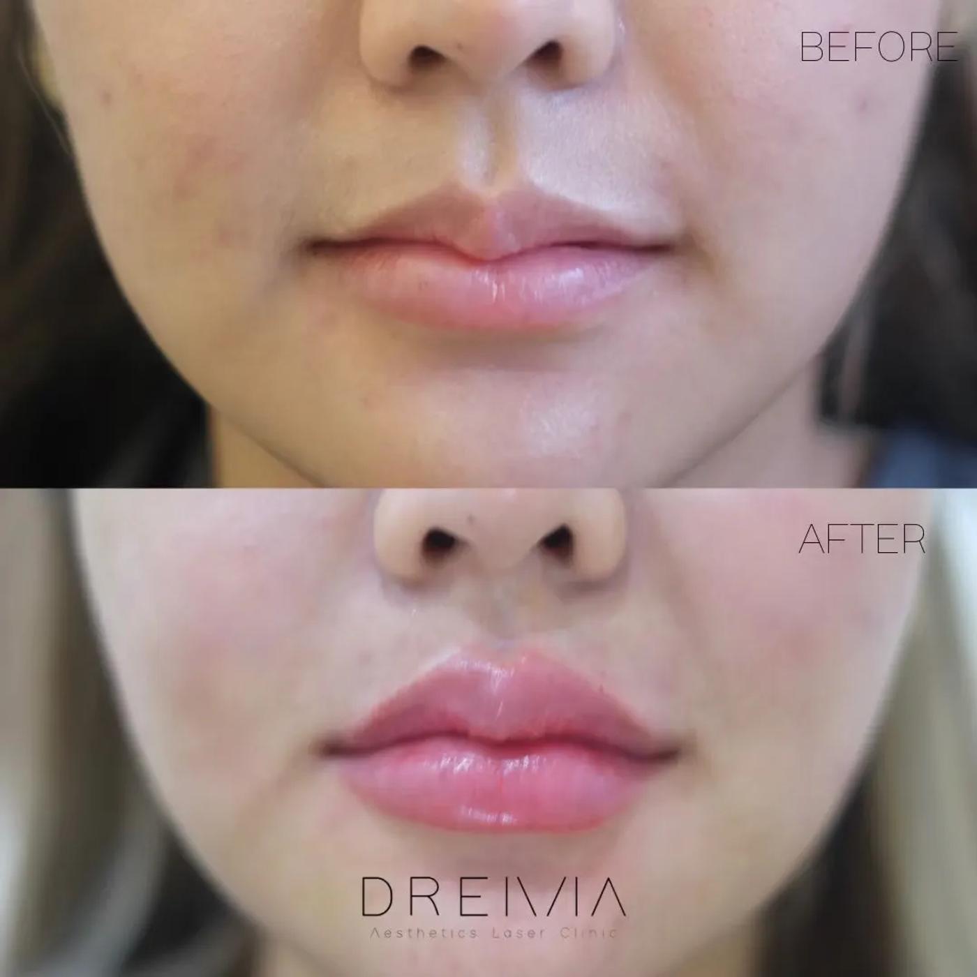 รีวิว Filler ปาก 40