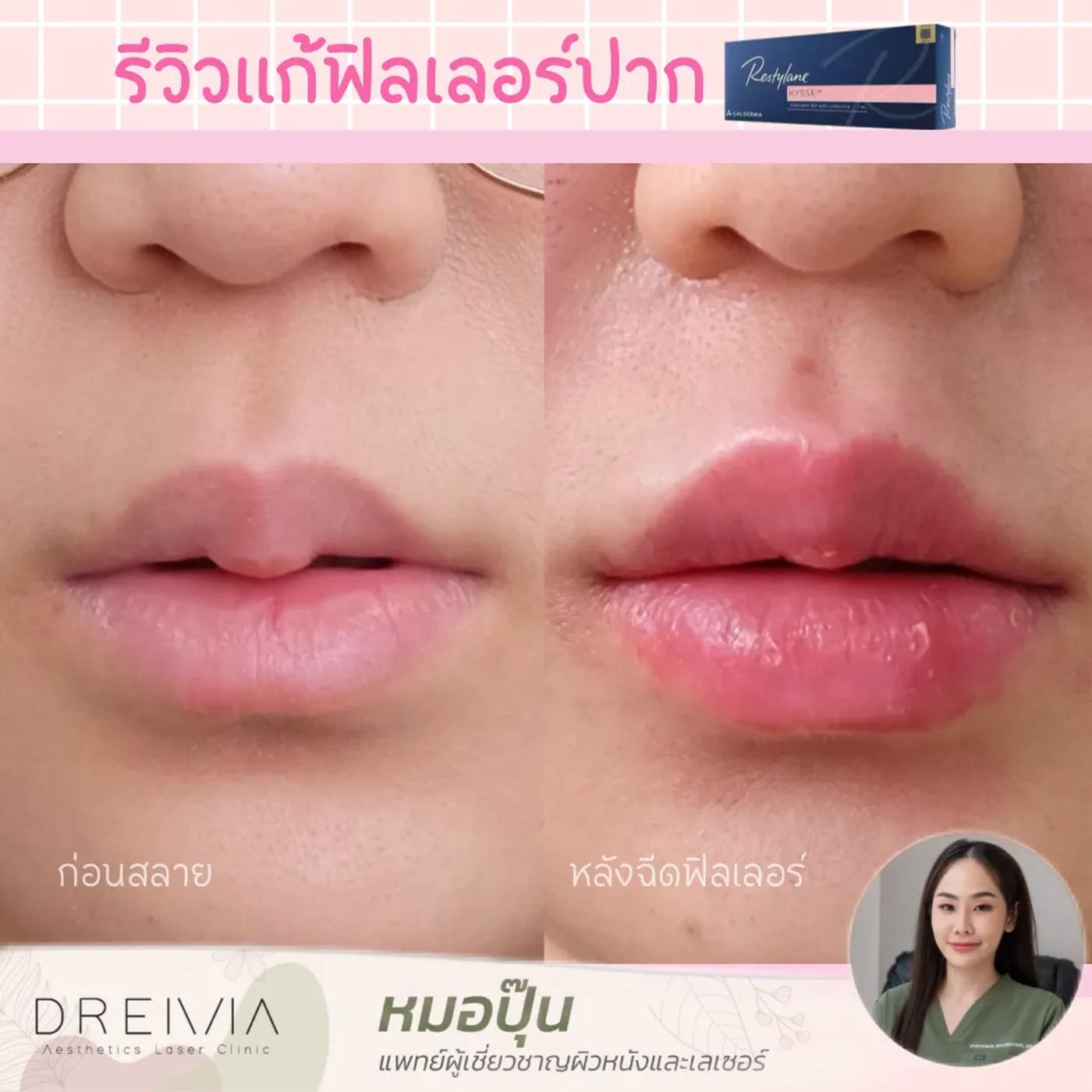 รีวิว Filler ปาก 5