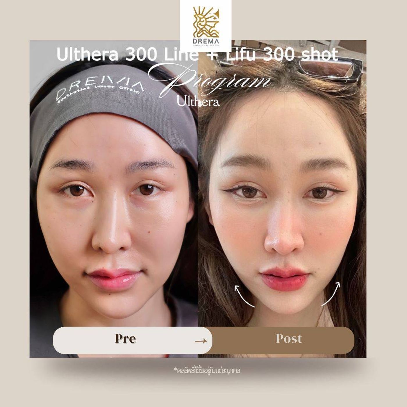รูปรีวิว Ulthera Drema Clinic เคสที่ 5