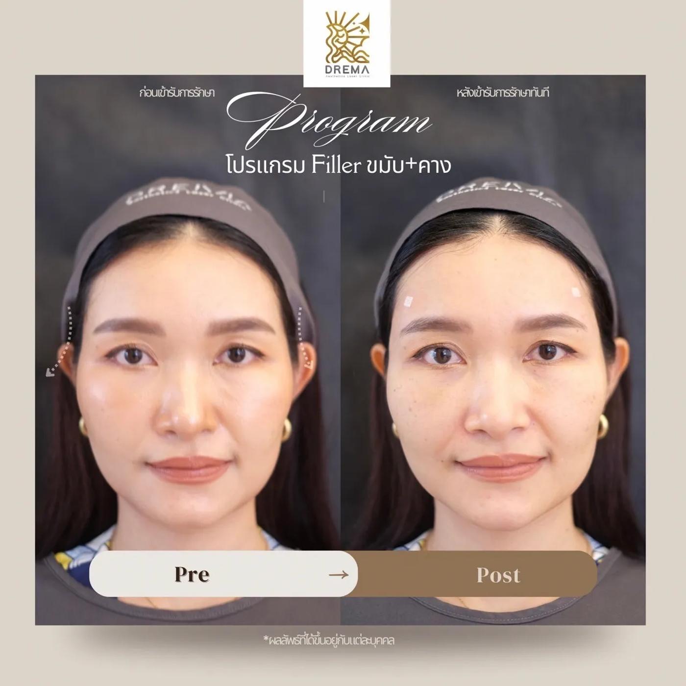 รีวิวการปรับรูปหน้า 8