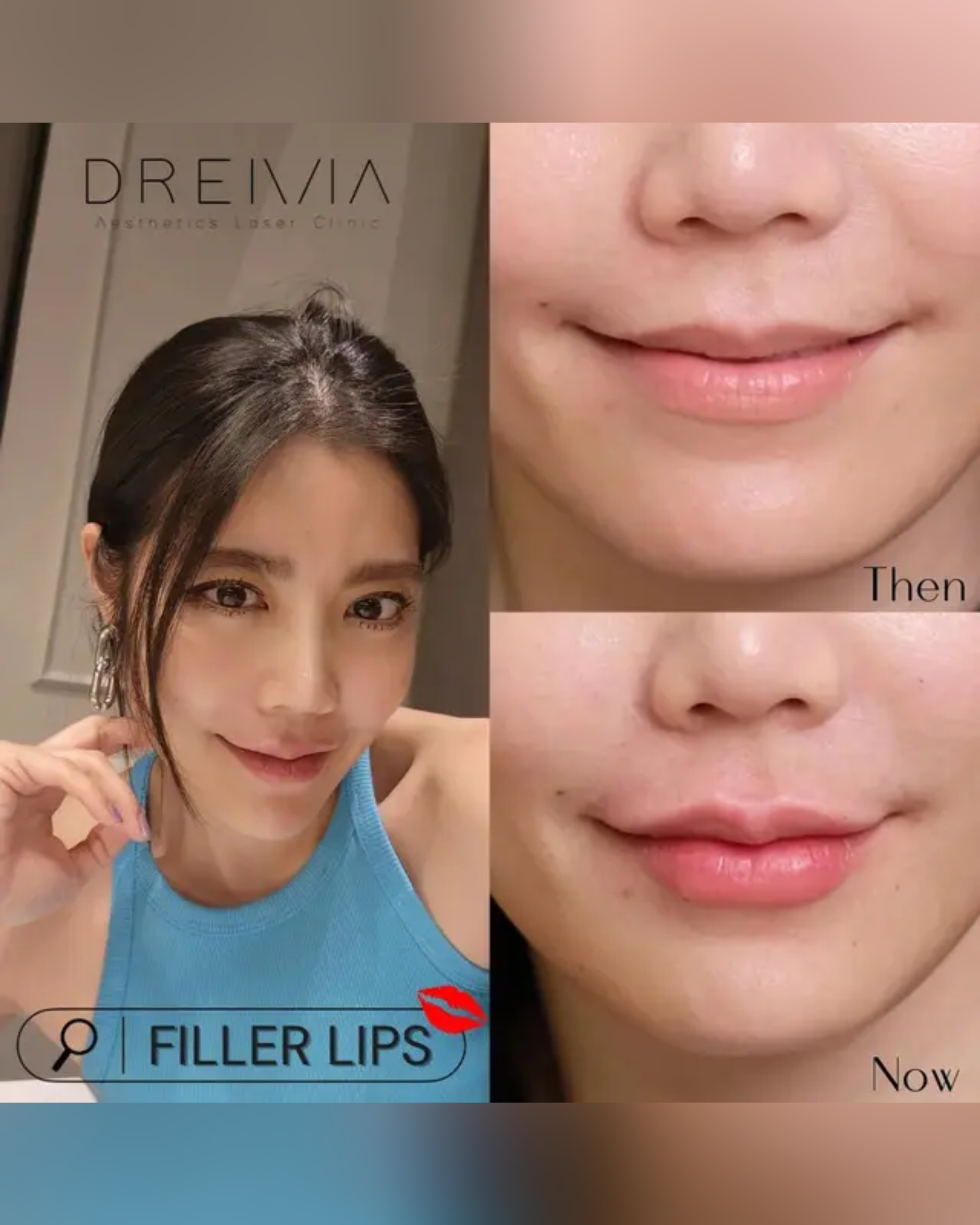 lipstick-after-filler - Drema Clinic