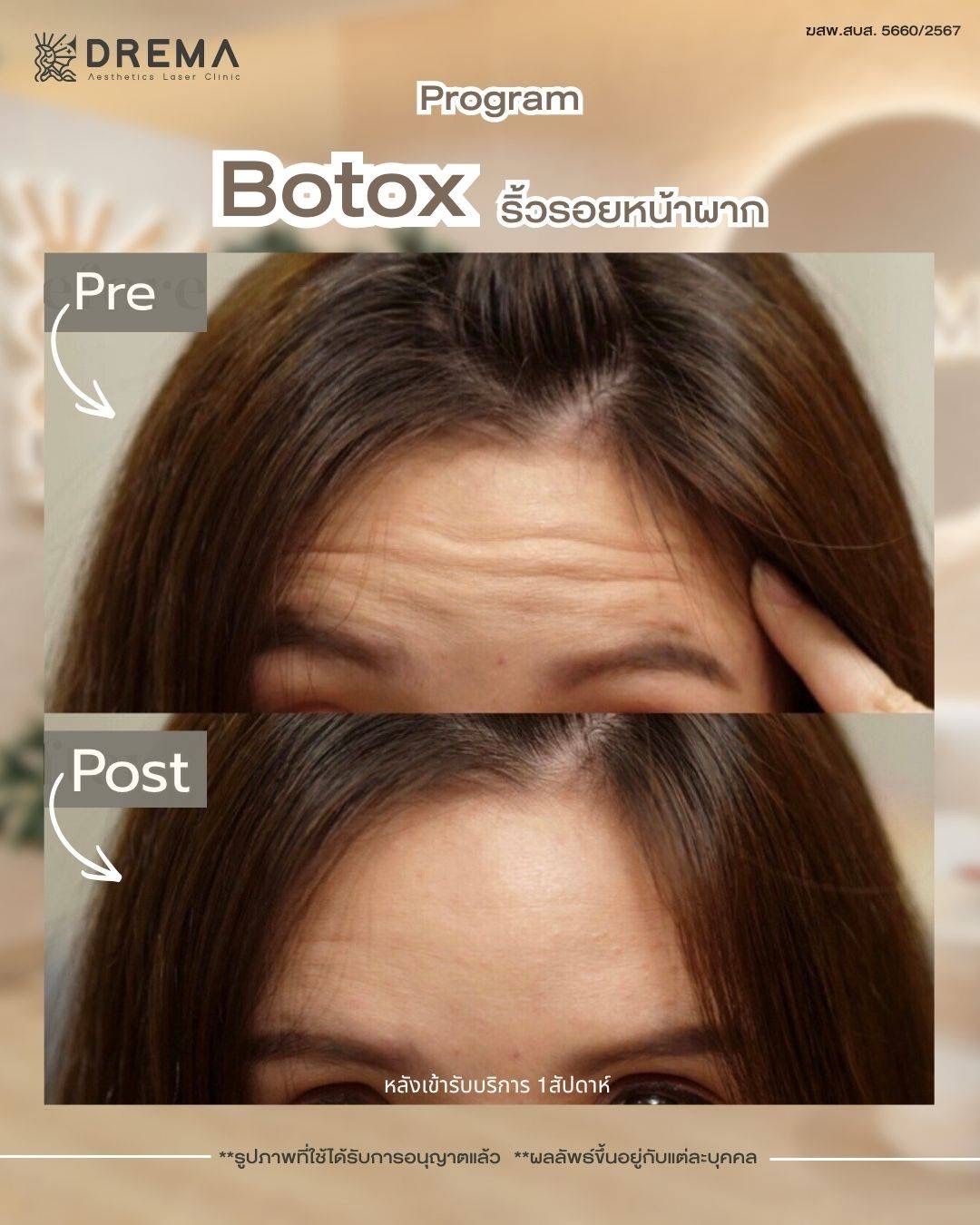 รูปรีวิว Botox Drema Clinic เคสที่ 5