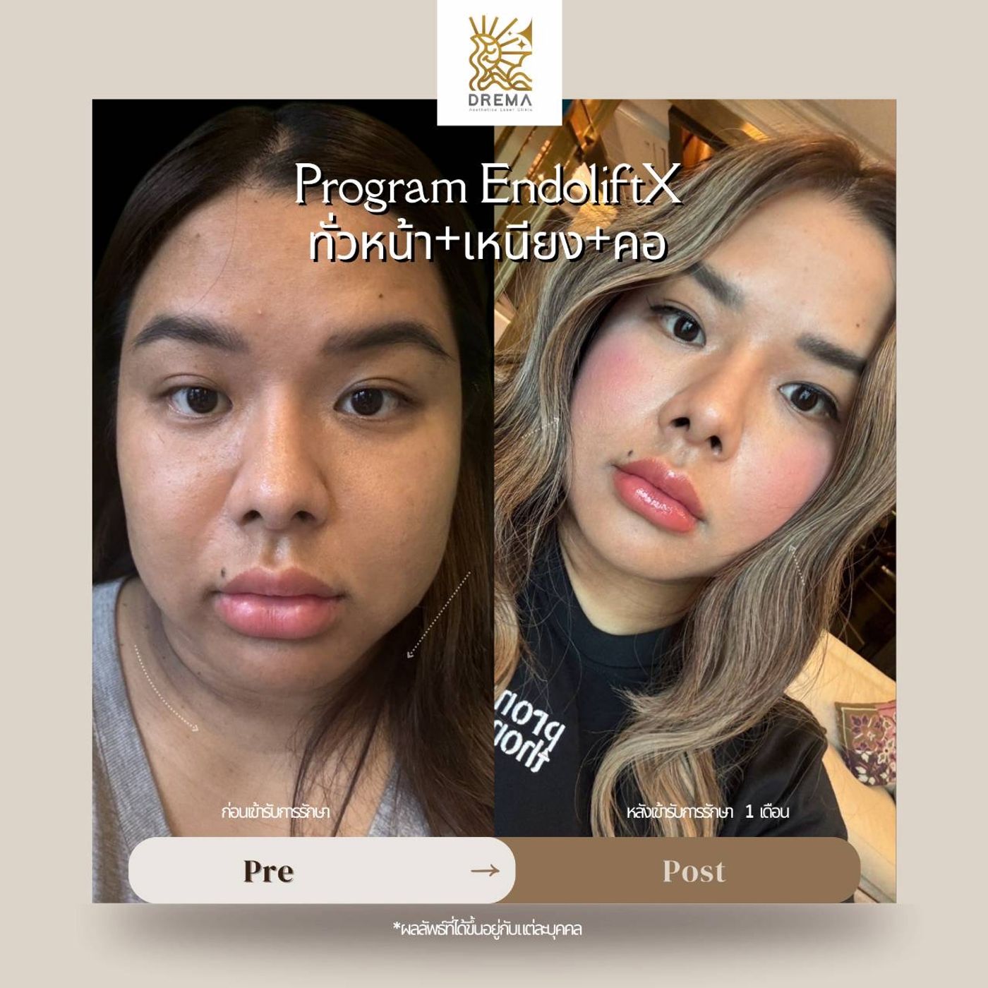 รูปรีวิว Endolift Drema Clinic เคสที่ 14