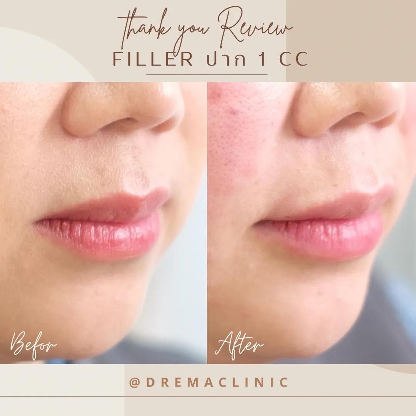 รีวิว Filler ปาก 16