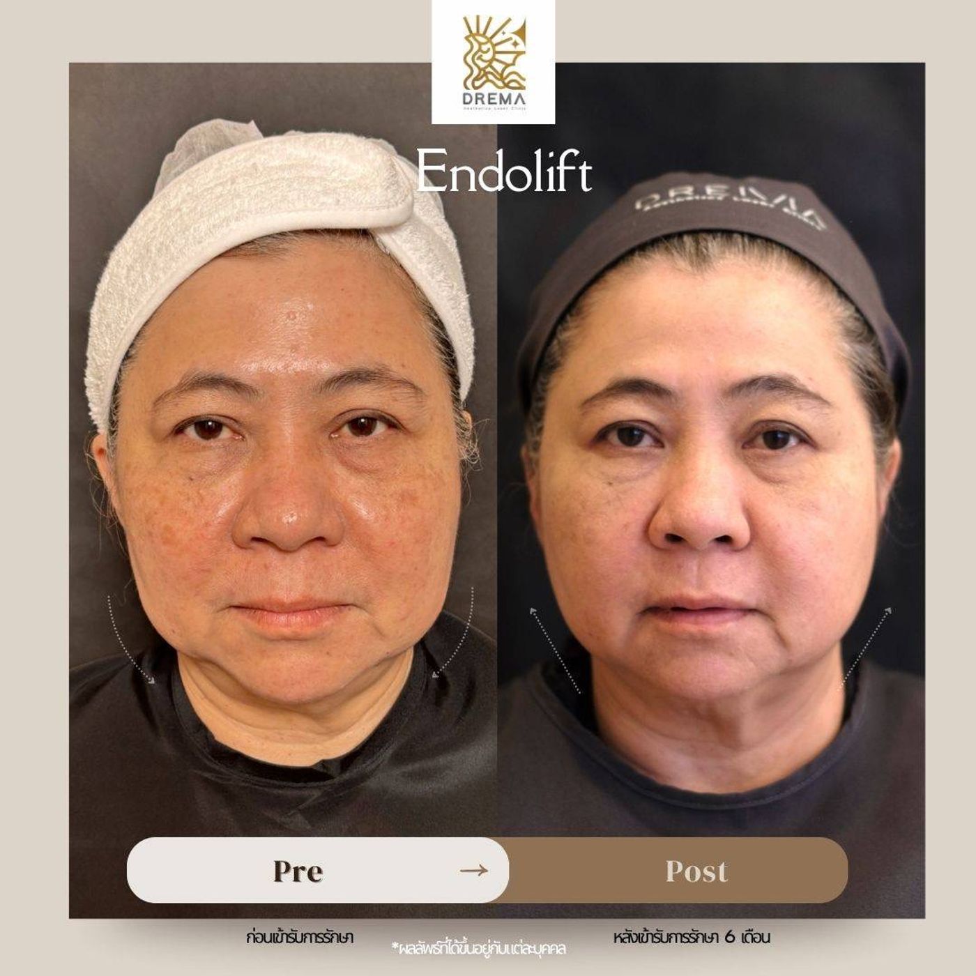 รูปรีวิว Endolift Drema Clinic เคสที่ 3