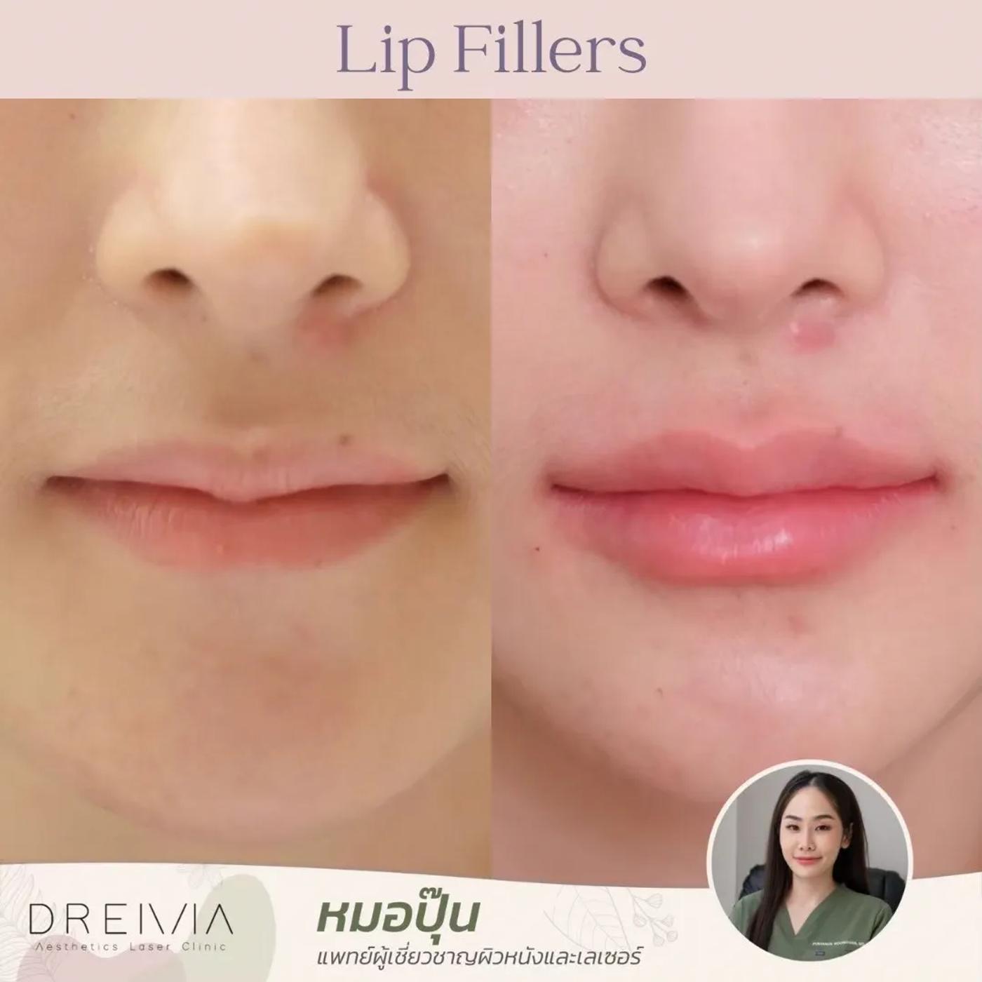 รีวิว Filler ปาก 27