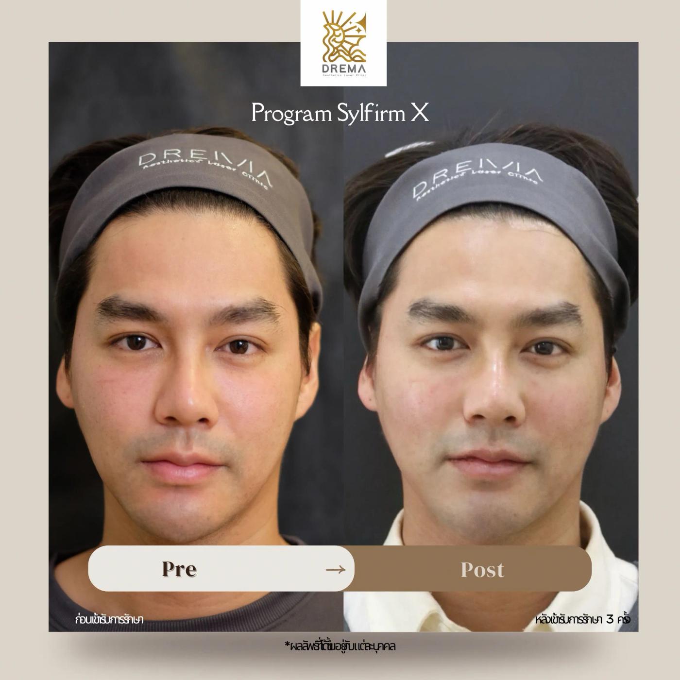 รีวิว SYLFIRM X 10