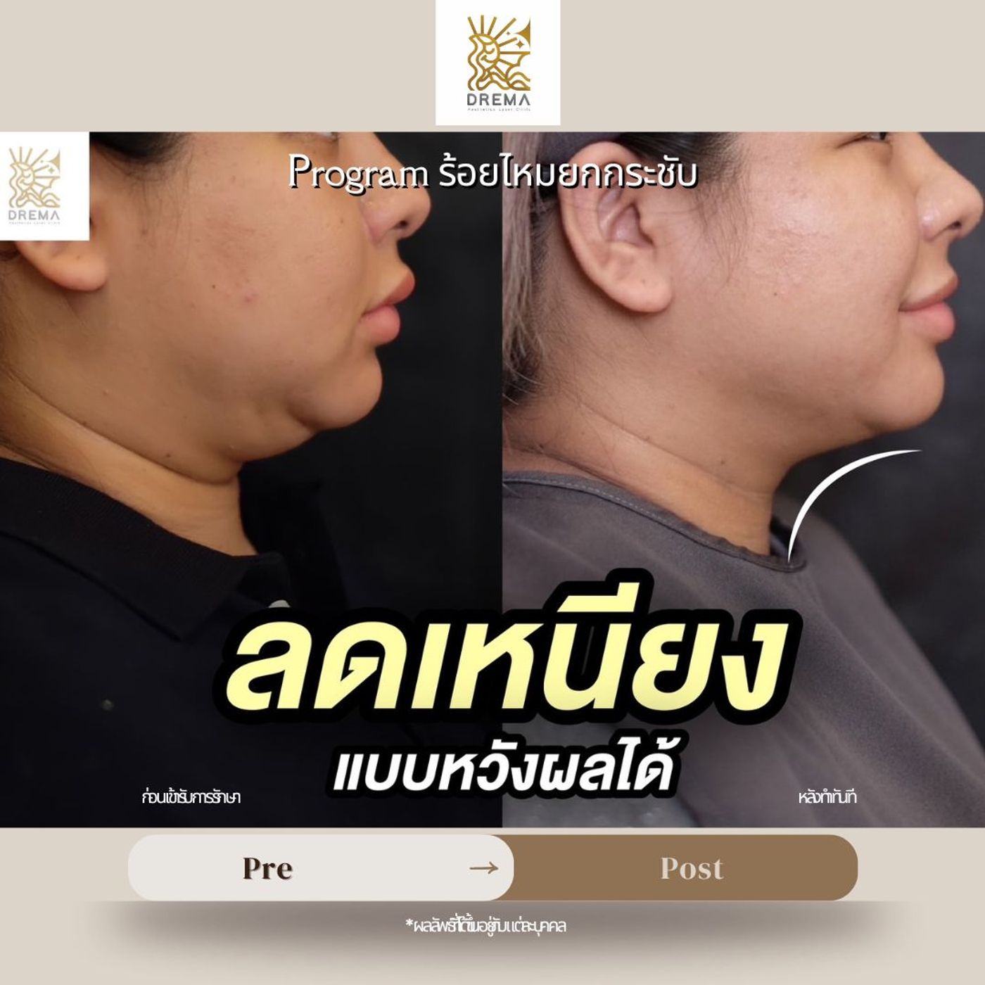รูปรีวิว ร้อยไหม Drema Clinic เคสที่ 4