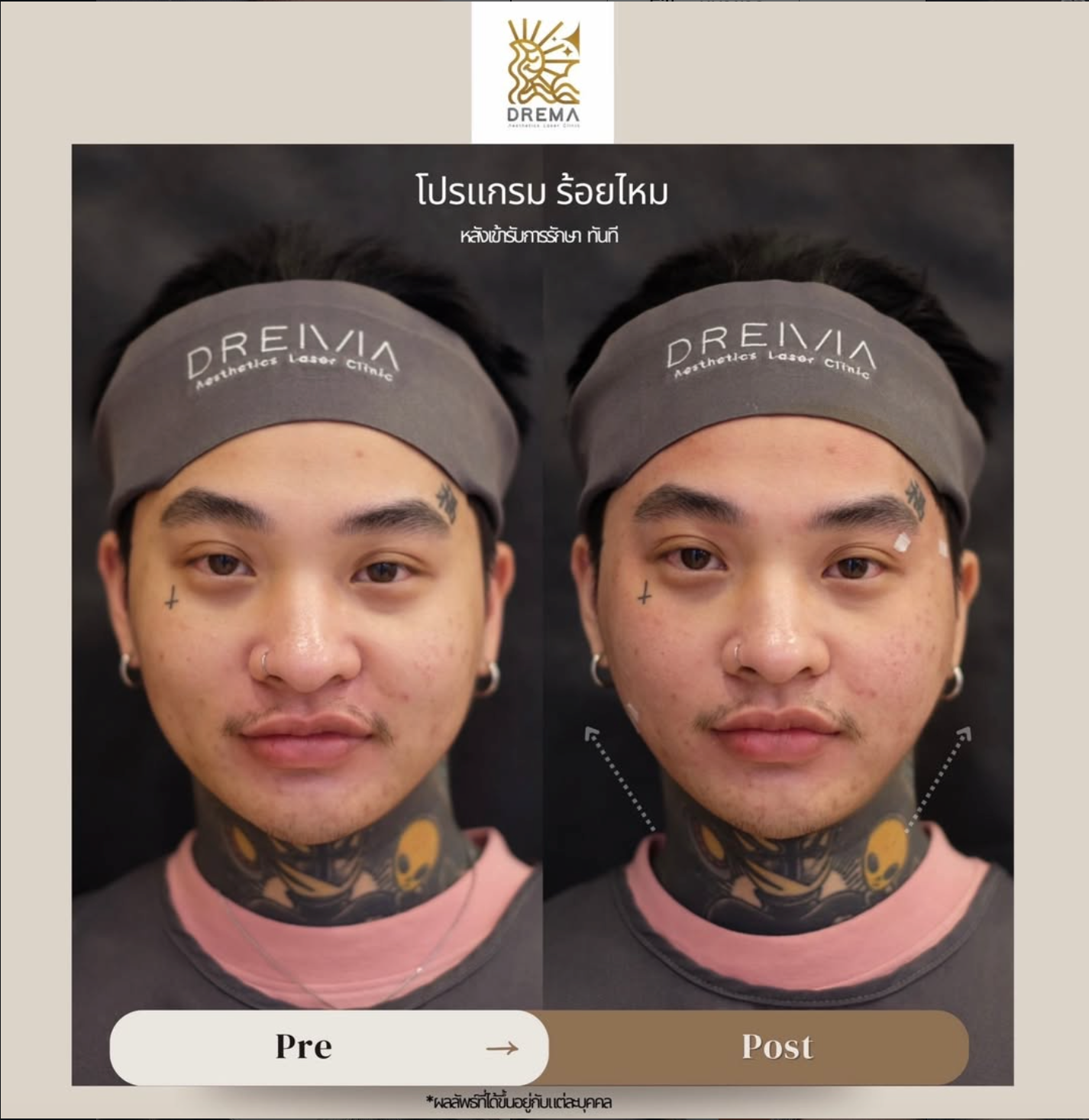 รีวิวร้อยไหม