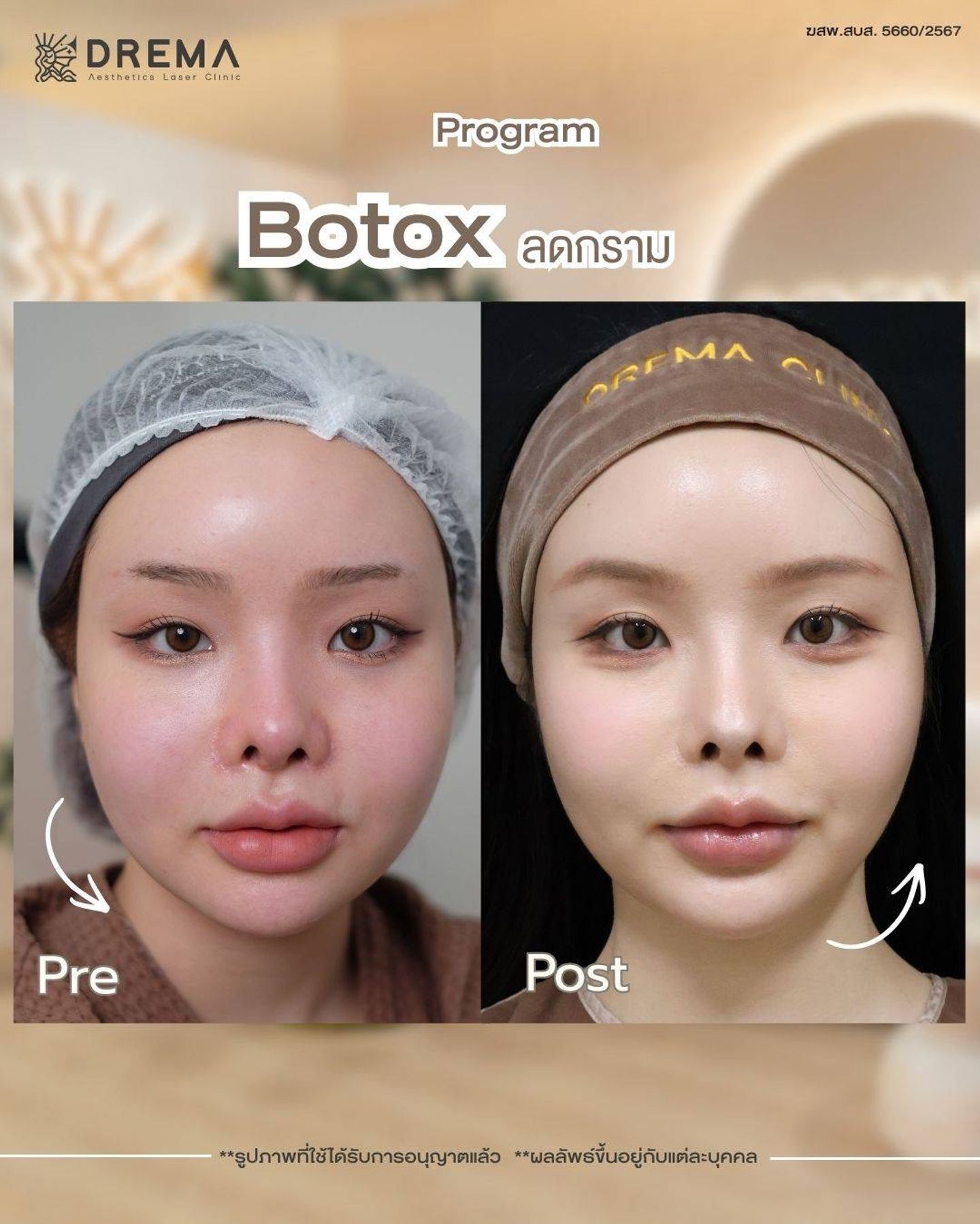 รีวิว Botox Drema Clinic