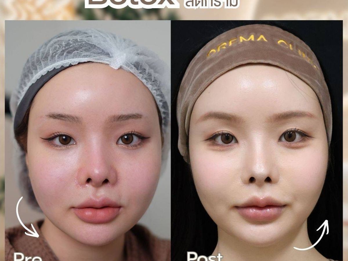 รีวิว Botox Drema Clinic