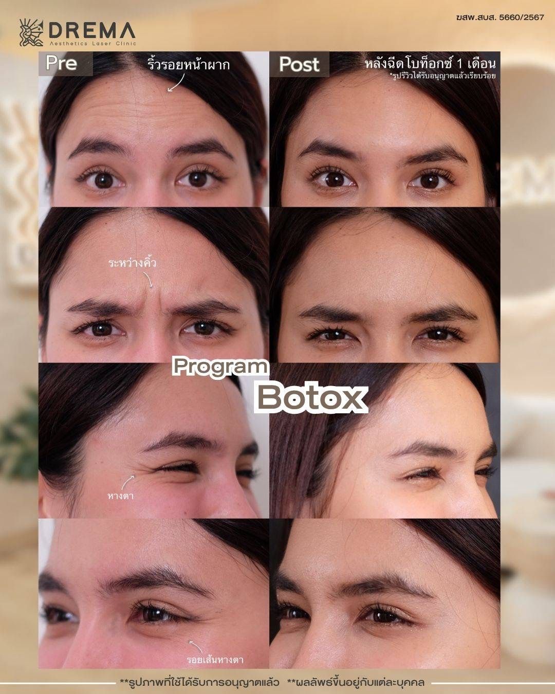รูปรีวิว Botox Drema Clinic เคสที่ 1