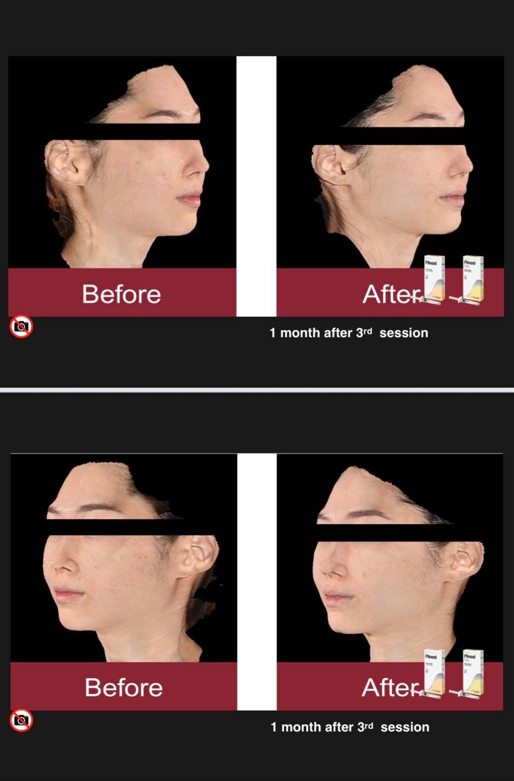 รูปรีวิว Skin Booster Drema Clinic เคสที่ 20