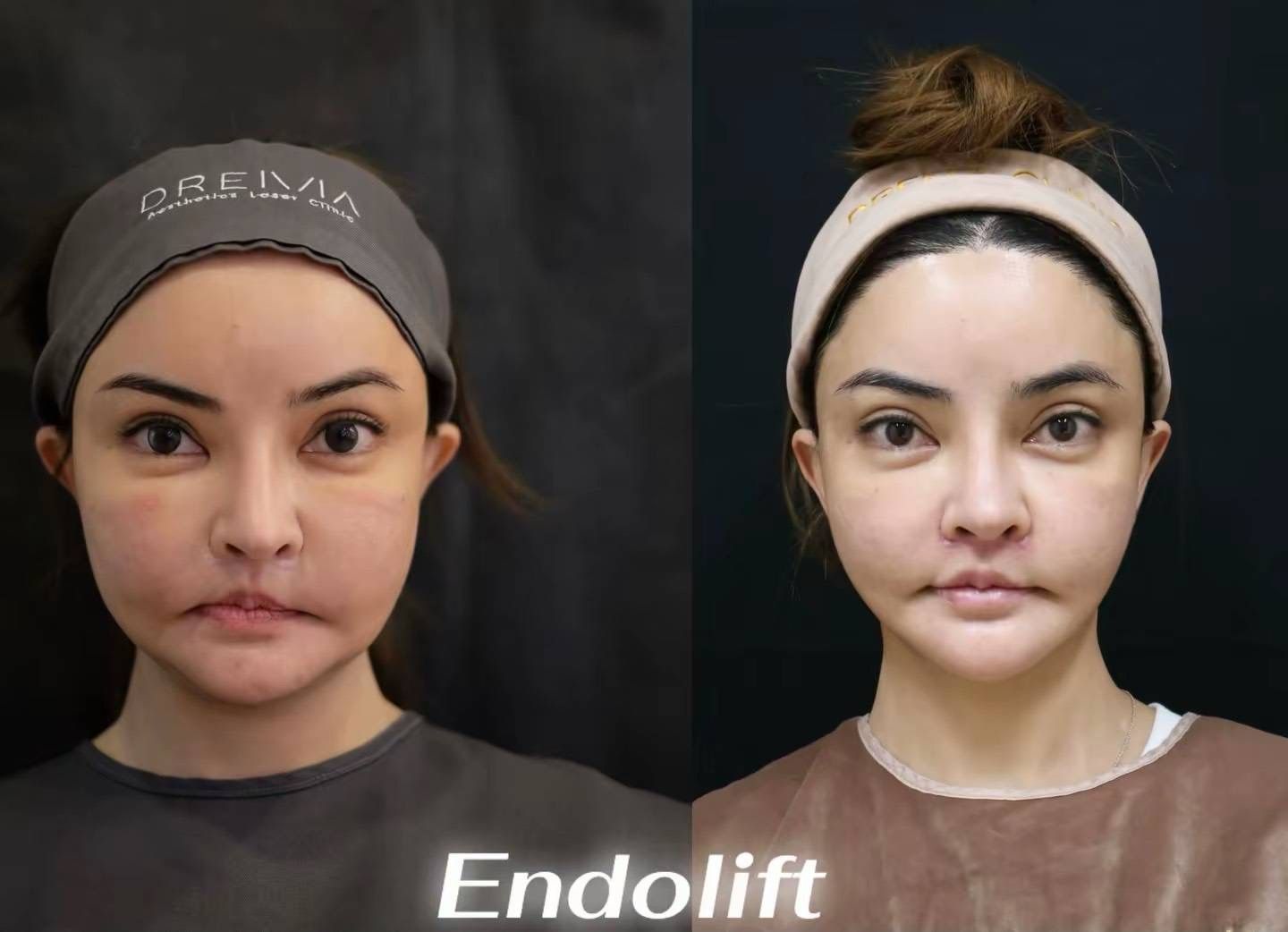 รูปรีวิว Endolift Drema Clinic เคสที่ 9