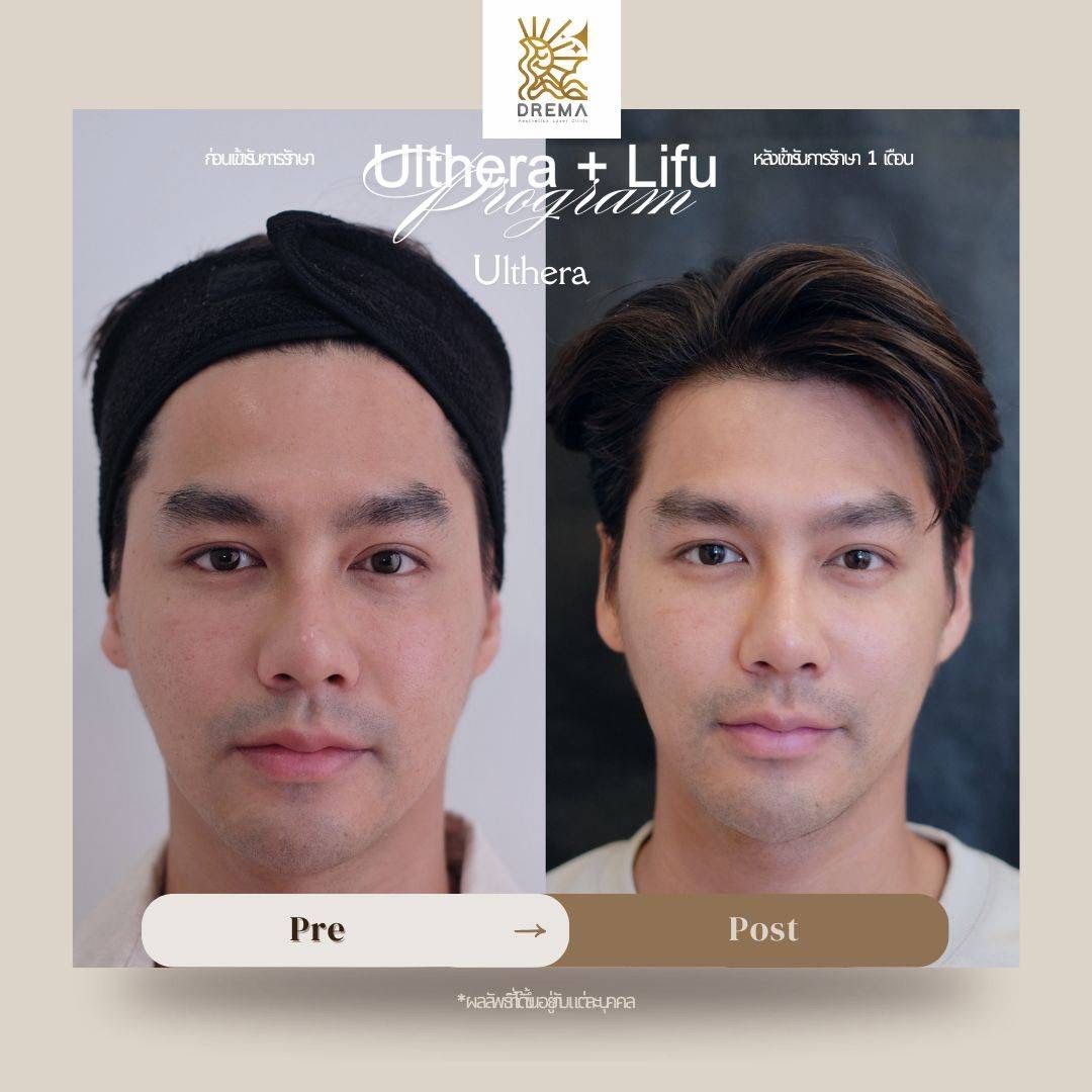 รีวิว Ulthera Drema Clinic