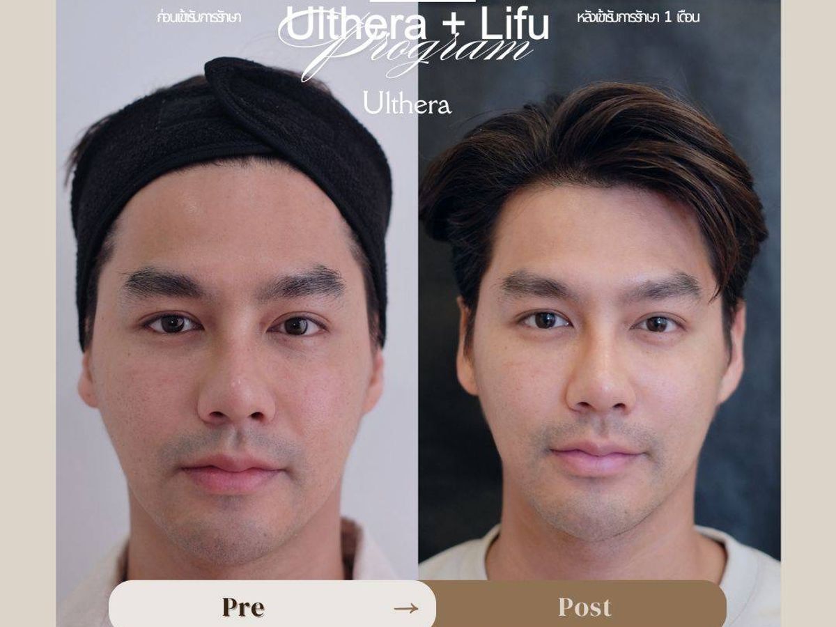 รีวิว Ulthera Drema Clinic