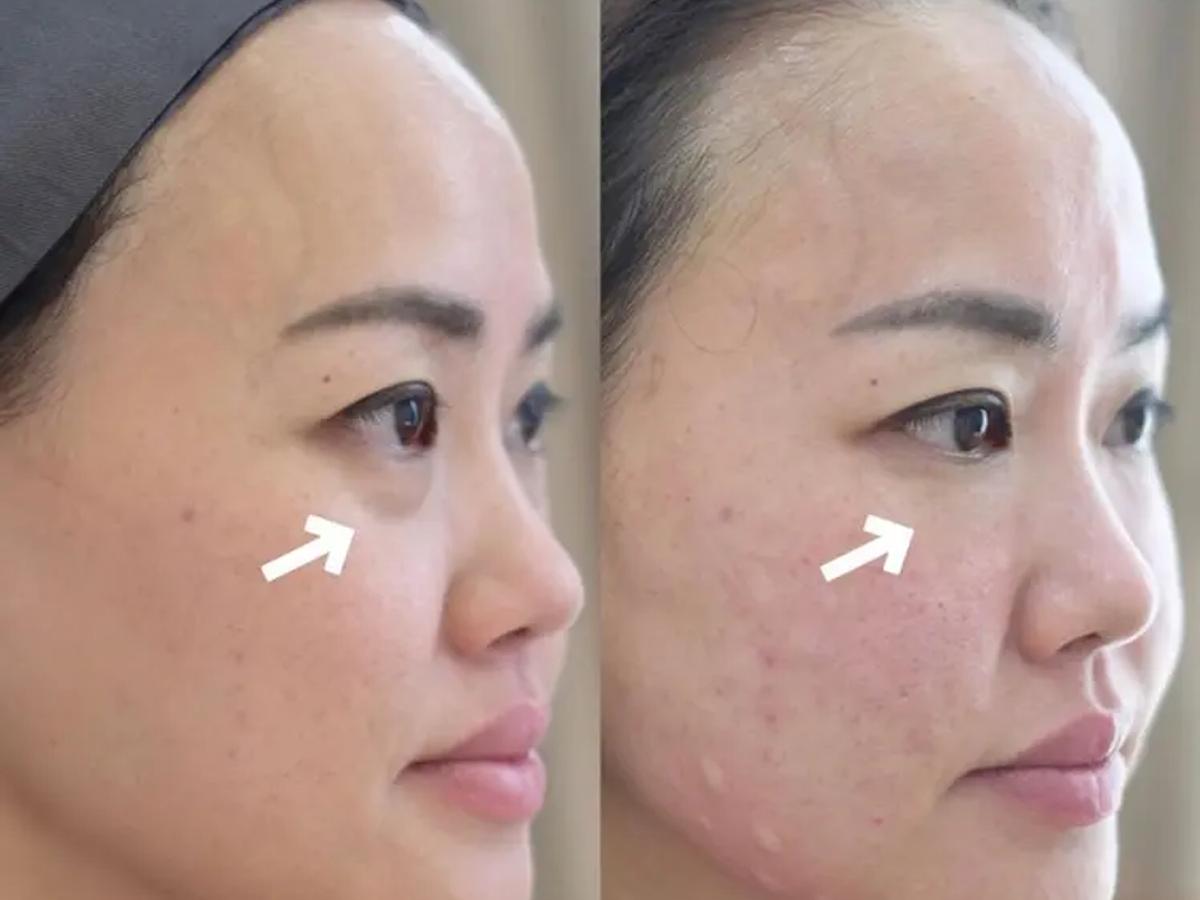 Under-Eye Filler Reviews